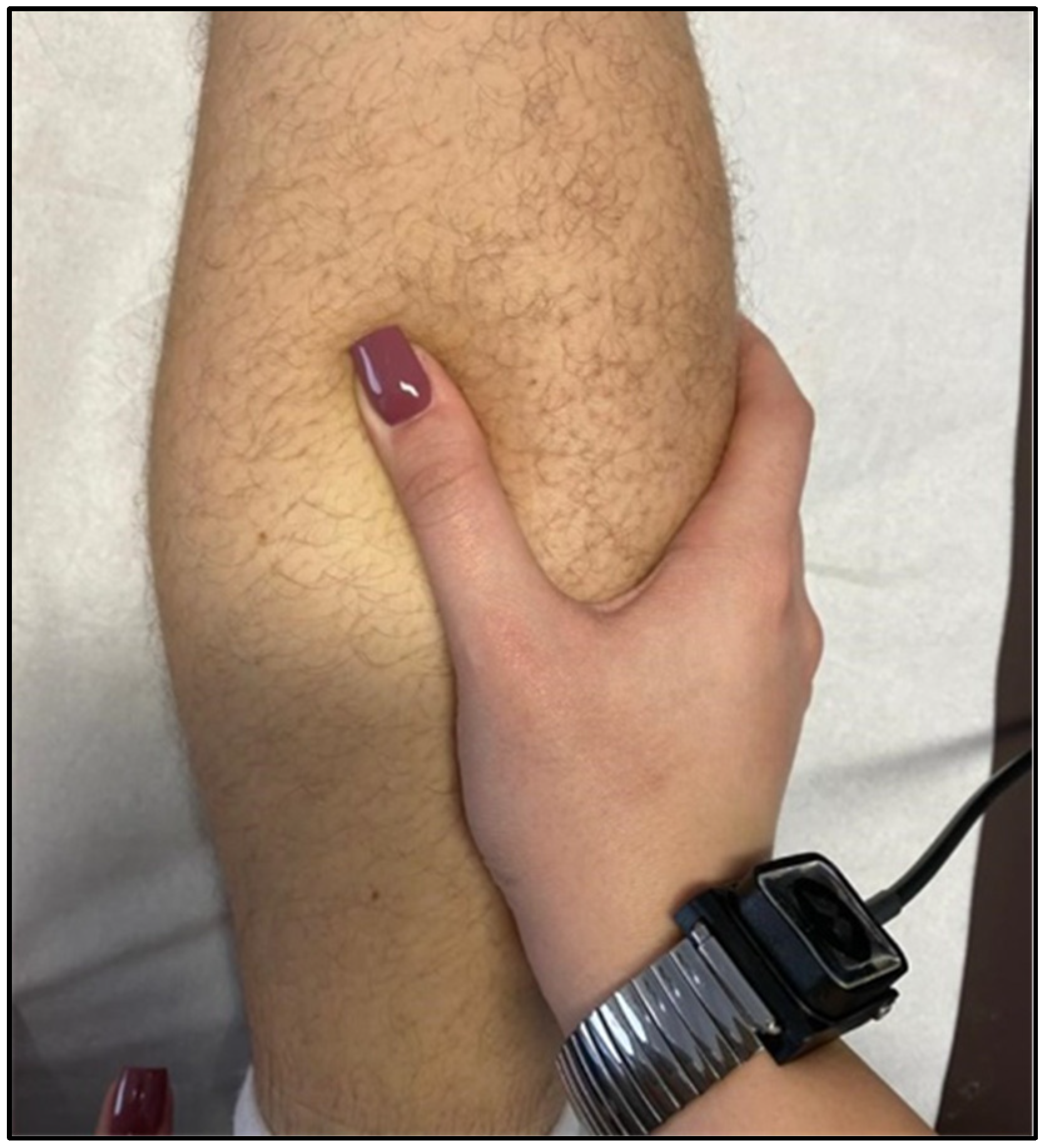 Utilizing intramuscular dry needling with electrical stimulation to inhibit  quadriceps following total knee replacement. In this case, patient's, By Physical Therapy Services of Wilmington