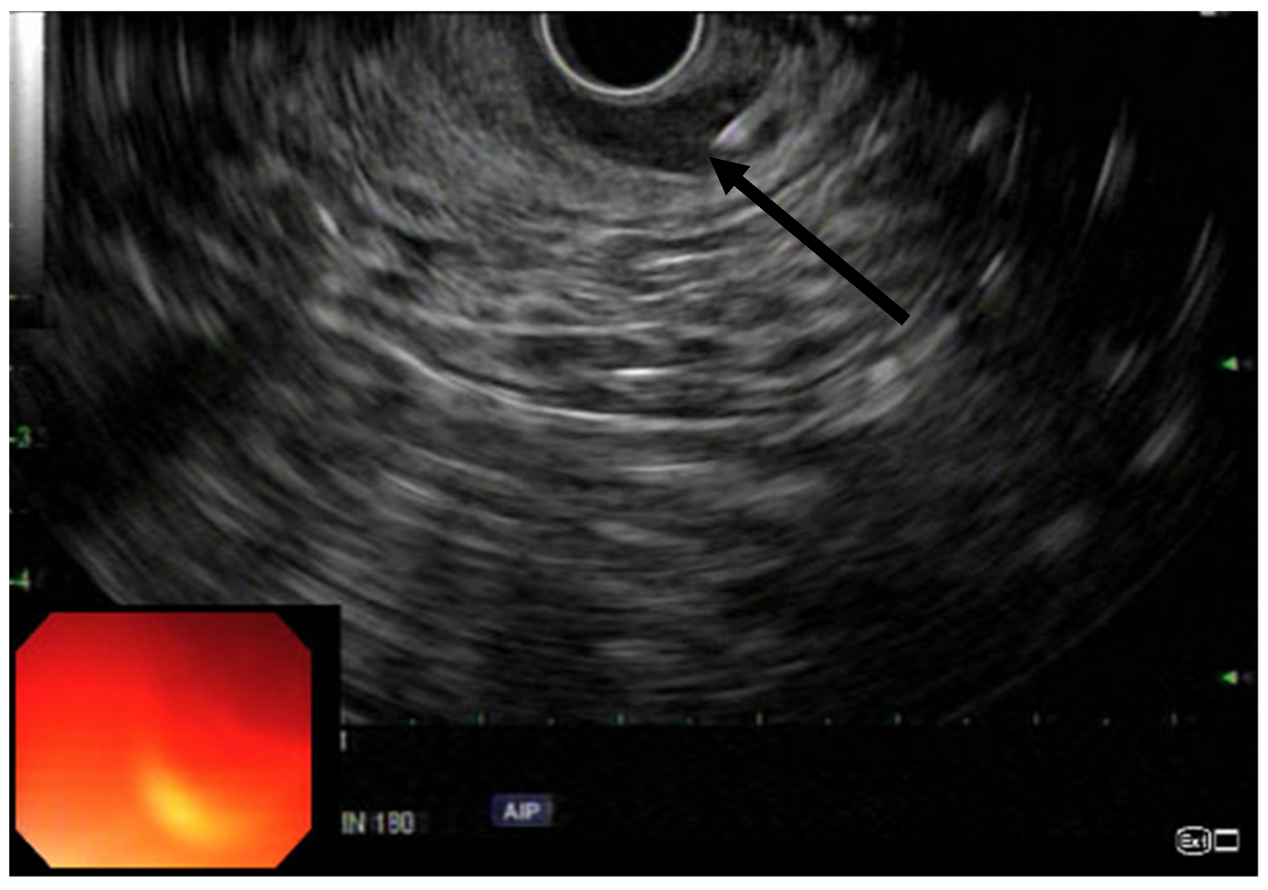 JCM | Free Full-Text | Endoscopic Ultrasound-Guided Botox Injection for  Refractory Anal Fissure