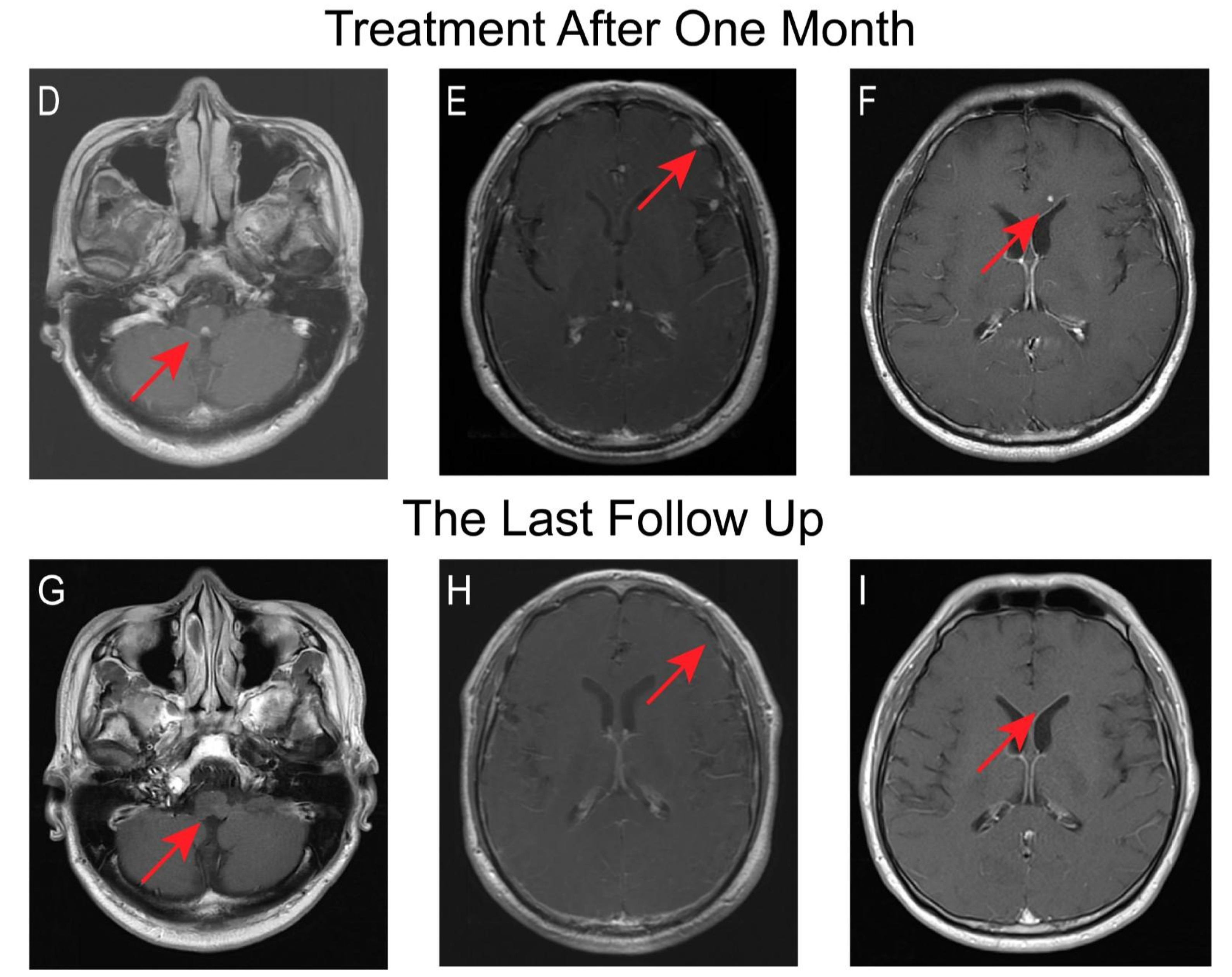 Clinical Management Of Pathogen Negative Tuberculous Meningitis In Clinical Management Of Pathogen Negative Tuberculous Meningitis In