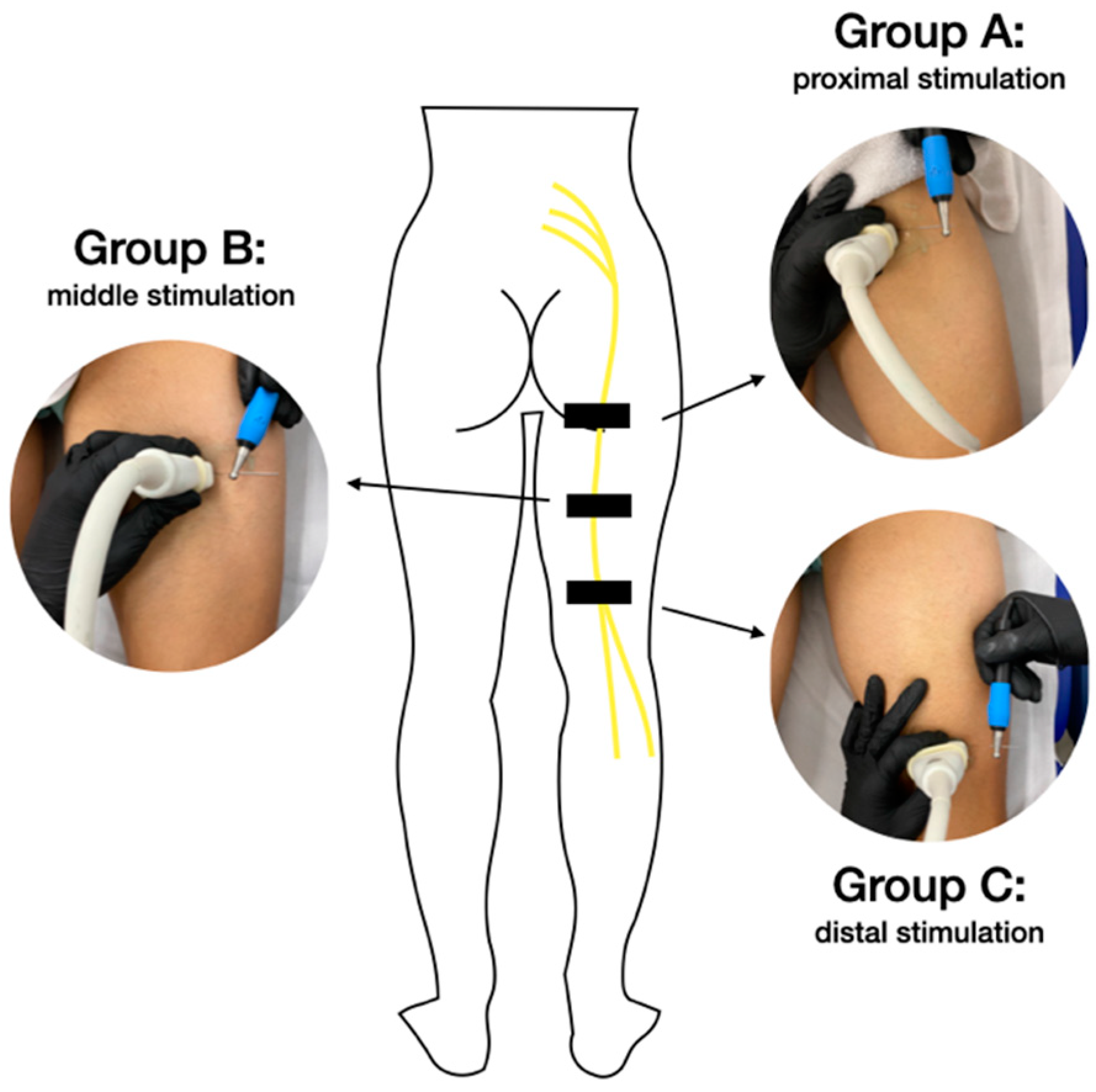 Percutaneous electrical nerve stimulation: an alternative to TENS in the  management of sciatica