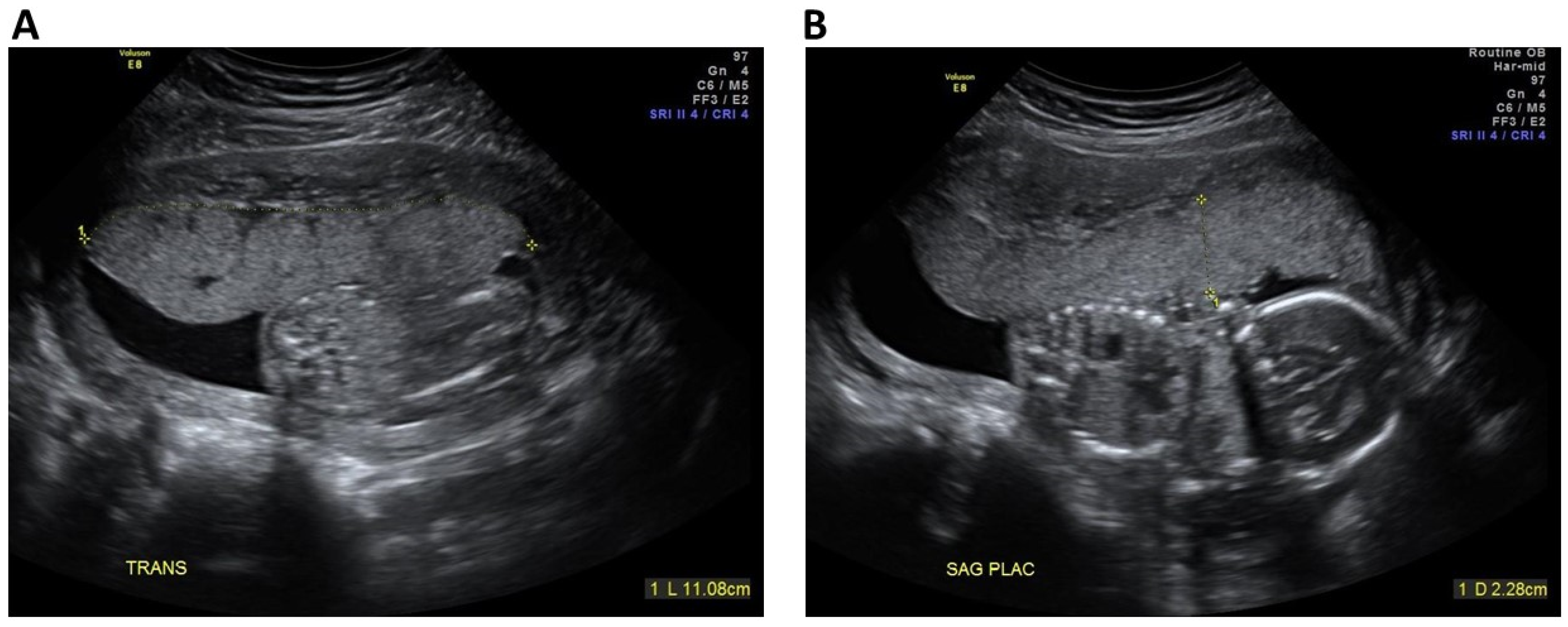 abnormal placenta ultrasound images