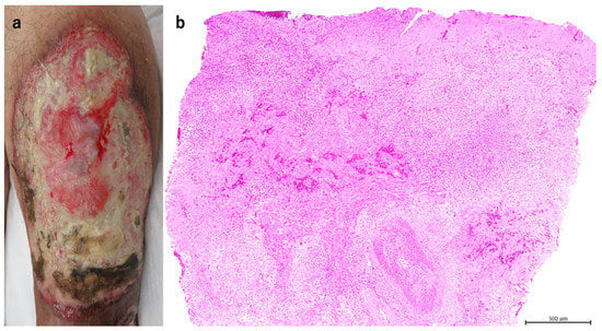 Treatment Strategy for Pyoderma Gangrenosum: Skin Grafting with ...