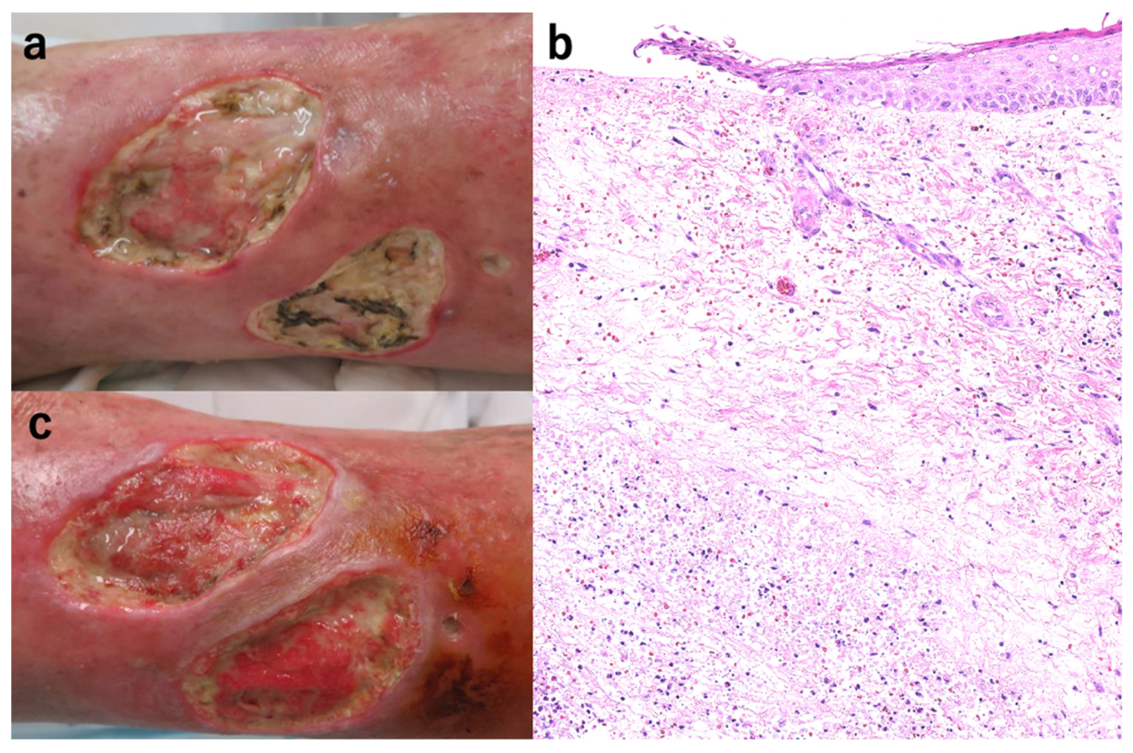 Treatment Strategy For Pyoderma Gangrenosum Skin Grafting With Treatment Strategy For Pyoderma Gangrenosum Skin Grafting With