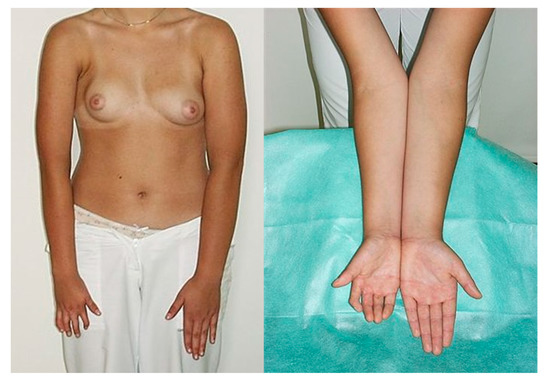 🥇 Dallas TX Poland Syndrome Female Breast Surgery