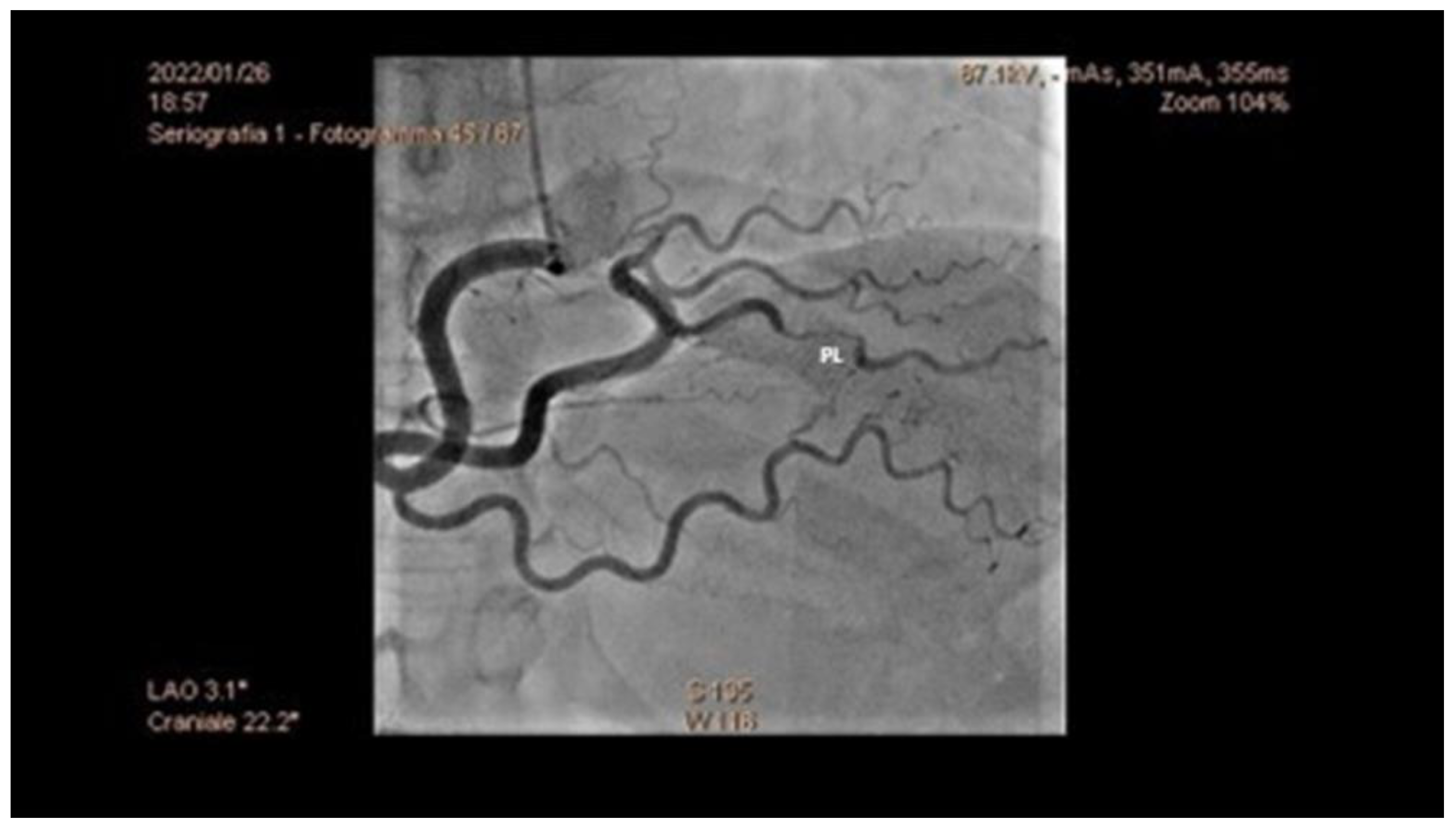 PDF) Sex differences in coronary angiographic findings in patients