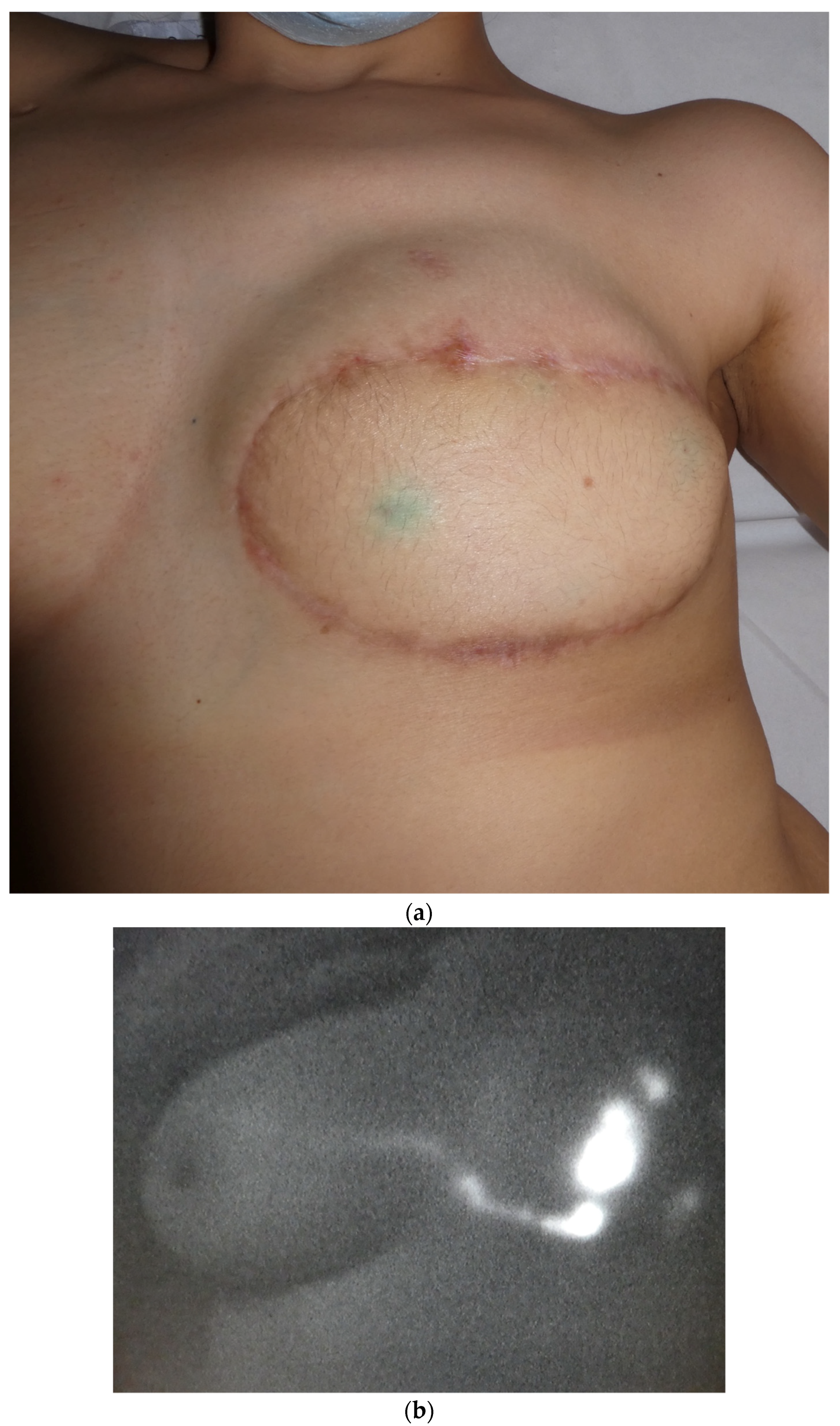 What to Expect from Nipple Correction Surgery: Sasaki Advanced Aesthetic  Medical Center: Cosmetic Plastic Surgeons