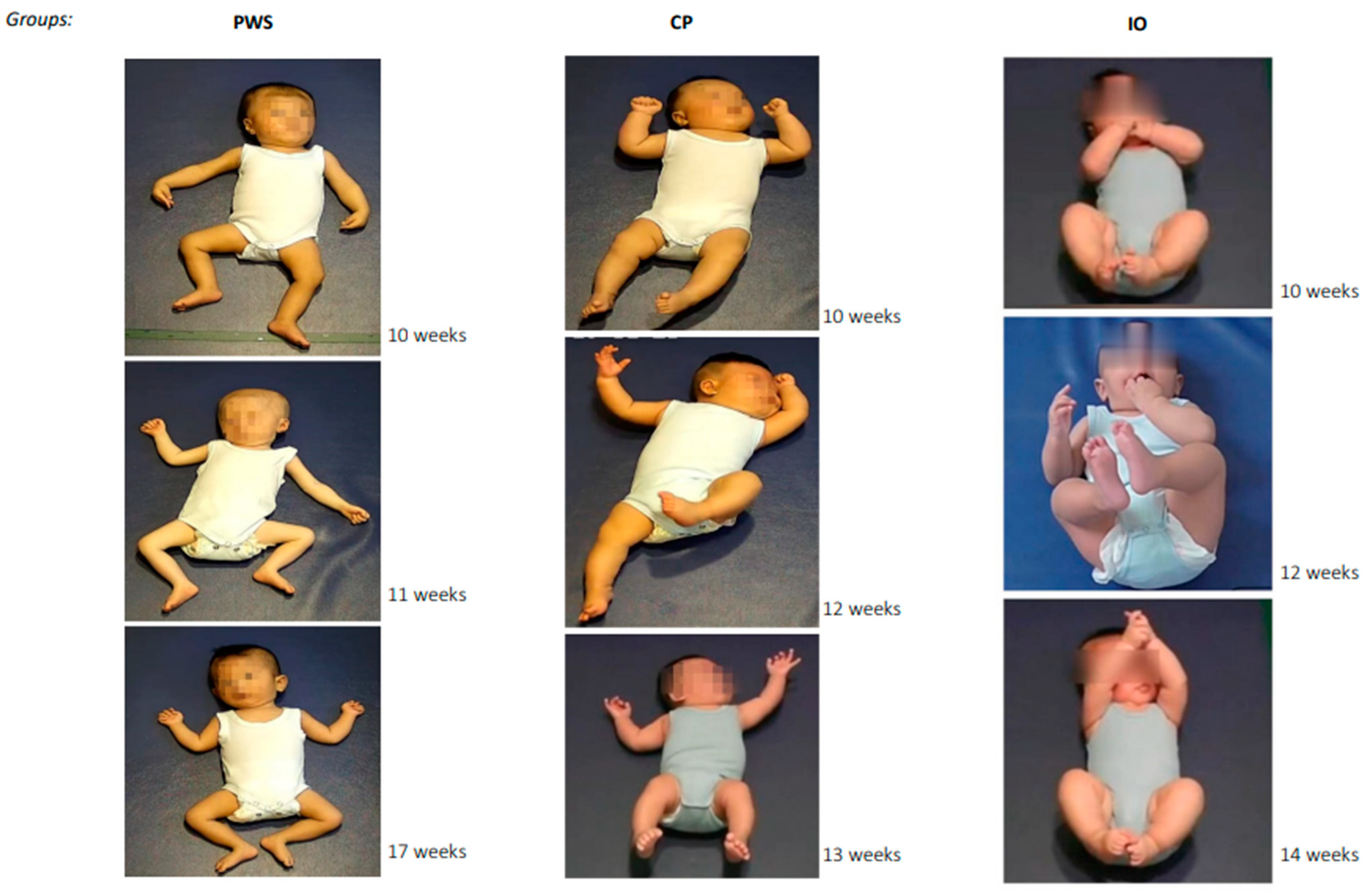 JCM | Free Full-Text | Building Blocks for Deep Phenotyping in Infancy: A  Use Case Comparing Spontaneous Neuromotor Functions in Prader-Willi Syndrome  and Cerebral Palsy