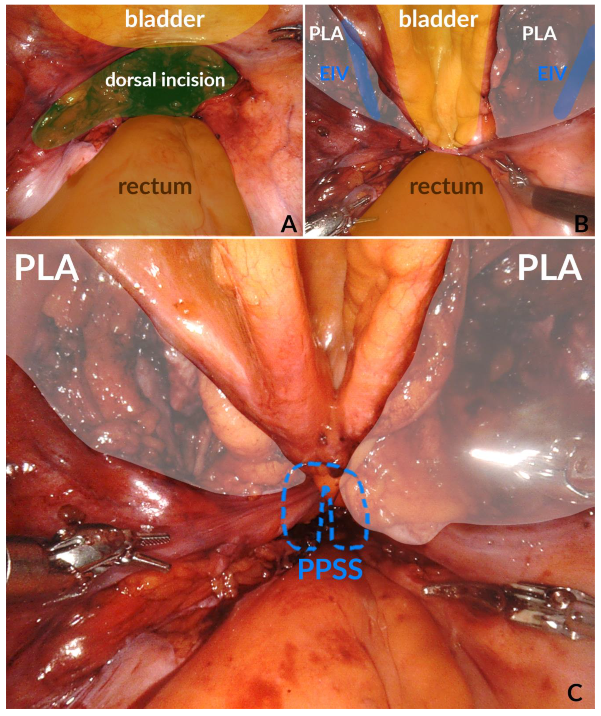 Frontiers | State-of-the-Art Review: Technical and Imaging Considerations  in Novel Transapical and Port-Access Mitral Valve Chordal Repair for  Degenerative Mitral Regurgitation