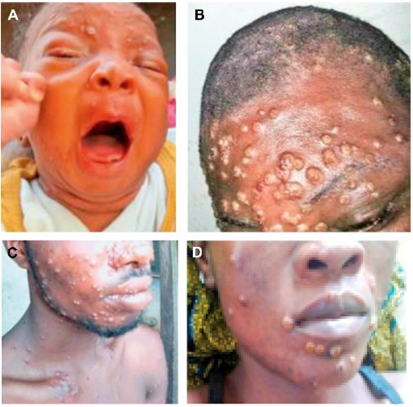 Neonatal Monkeypox Virus Infection
