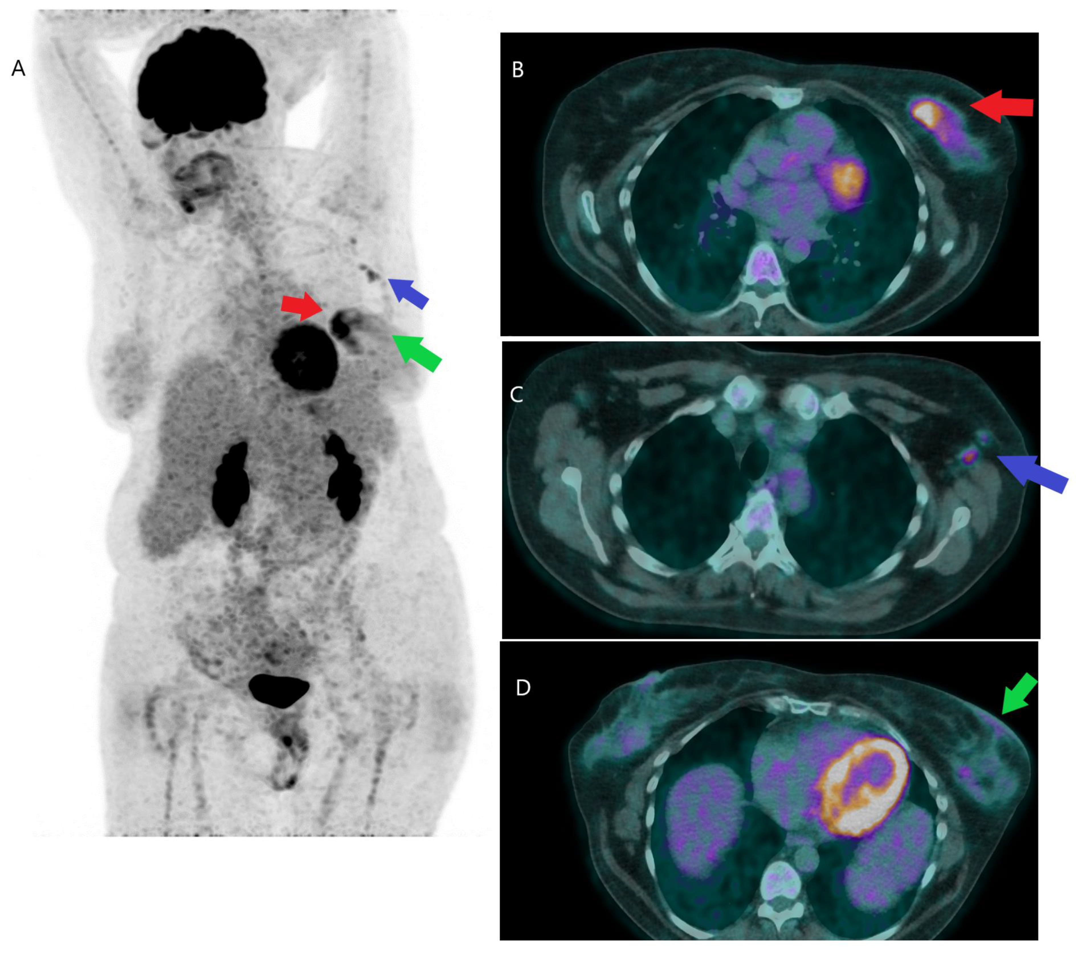 Micro CT picture of a breast carcinoma specimen.