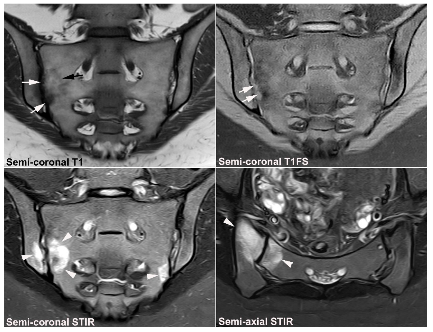 Arne dynasti grit JCM | Free Full-Text | Diagnostics of Sacroiliac Joint Differentials to  Axial Spondyloarthritis Changes by Magnetic Resonance Imaging