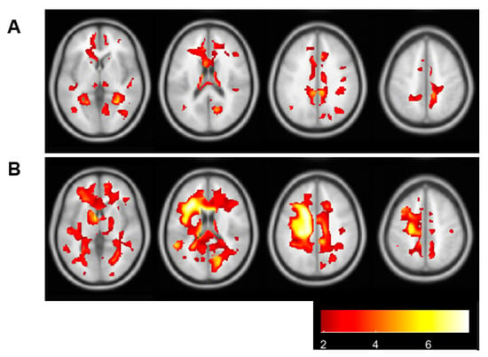 JCM | Free Full-Text | Association between White Matter ...