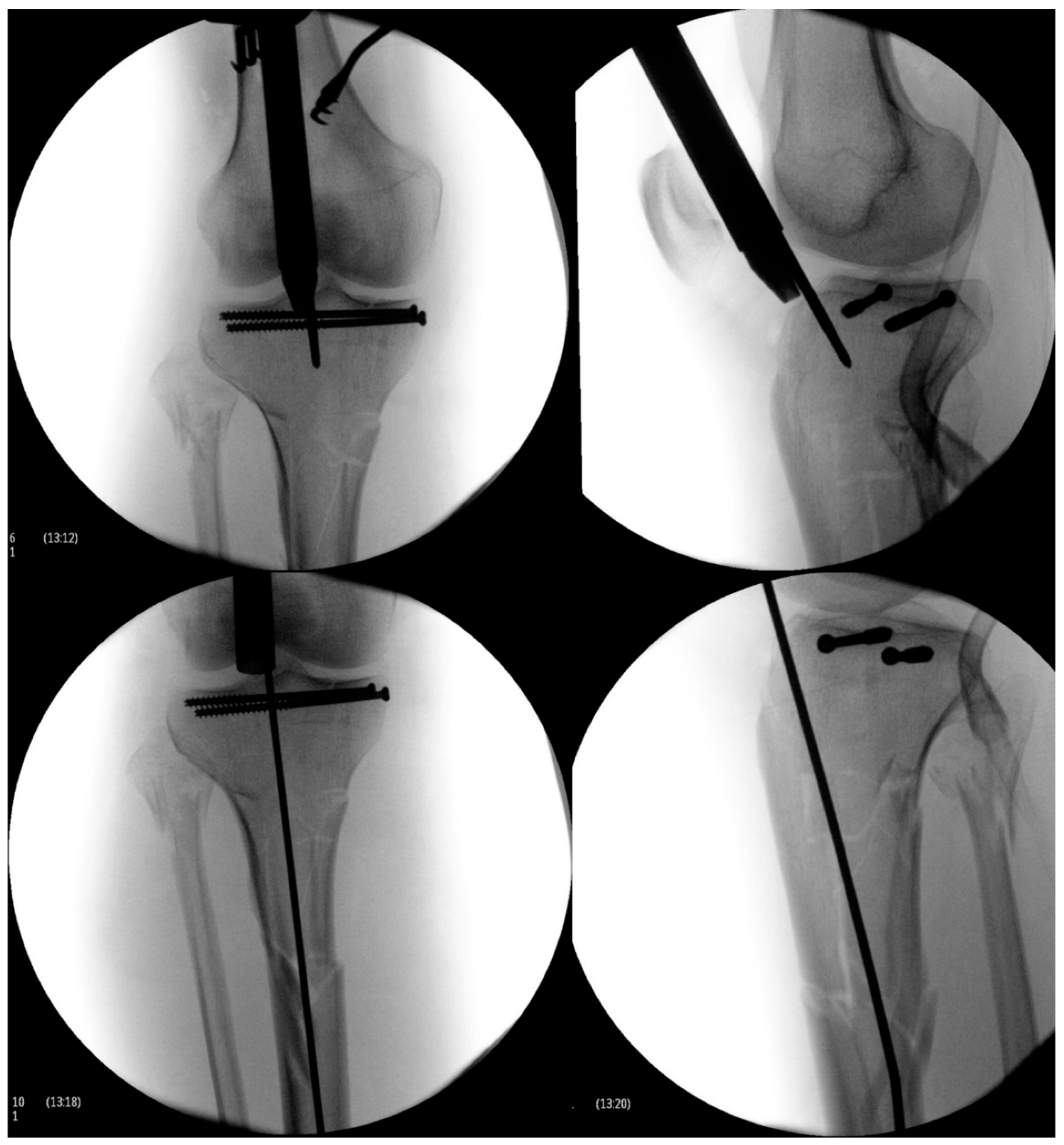 PDF) Complications and Subsequent Surgery after Intra-Medullary Nailing for  Tibial Shaft Fractures: Review of 8110 patients