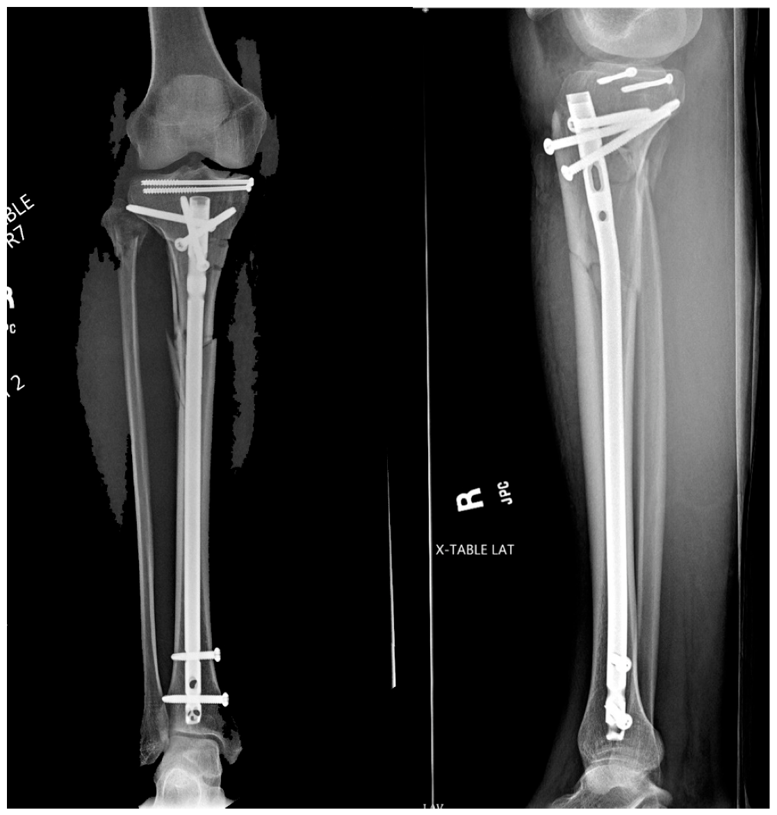 Suprapatellar Tibial Nailing Future Or Fad Suprapatellar Tibial Nailing Future Or Fad