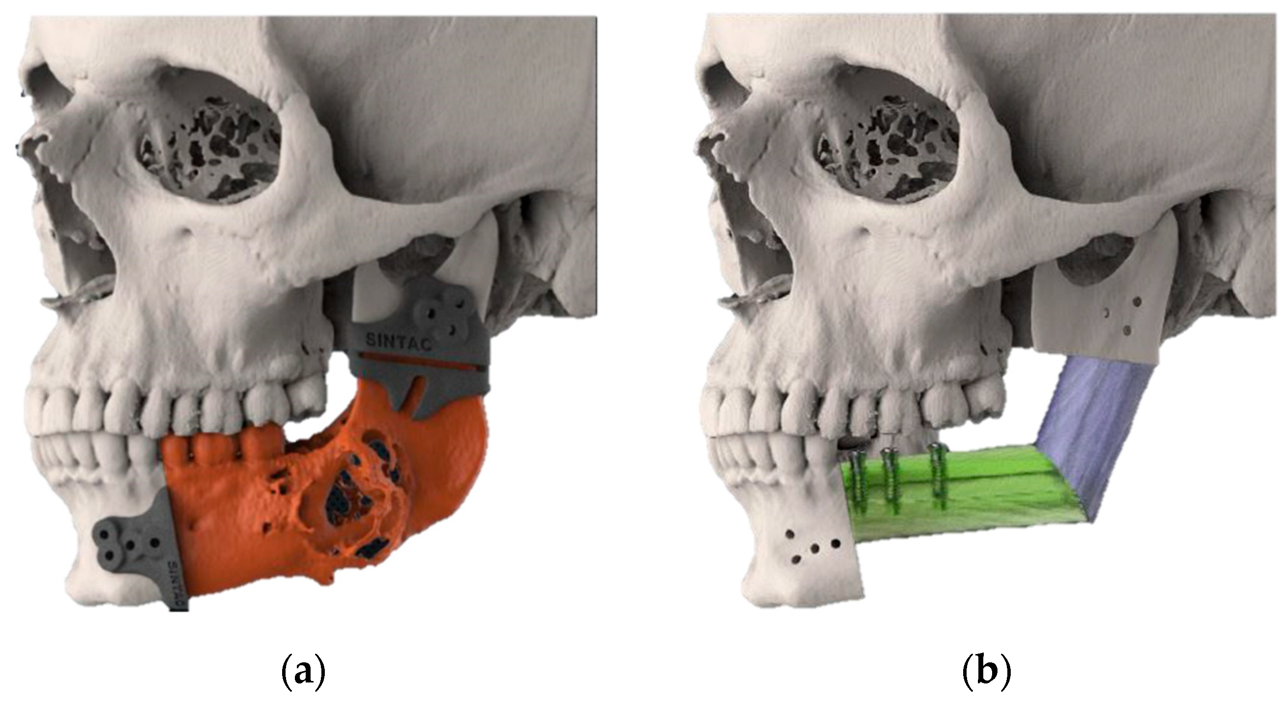 Accuracy Evaluation Of An Alternative Approach For A CAD AM Mandibular Accuracy Evaluation Of An Alternative Approach For A CAD AM Mandibular