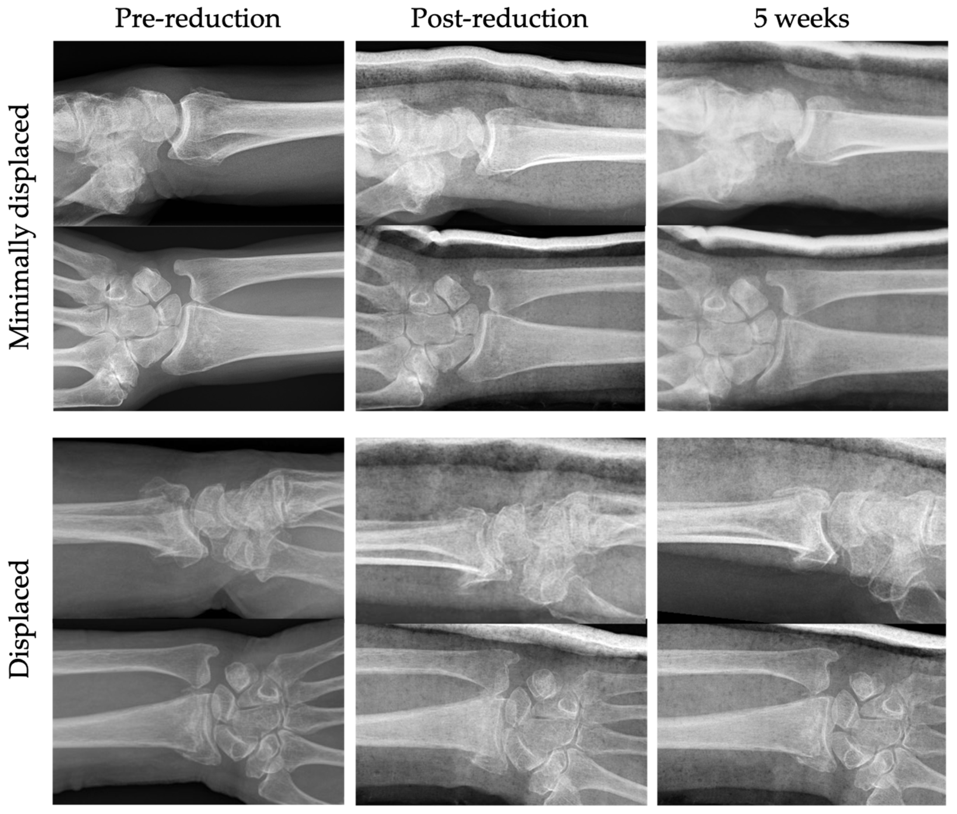 Prospective Evaluation Of Two Cohorts Of Non Operatively Treated Prospective Evaluation Of Two Cohorts Of Non Operatively Treated