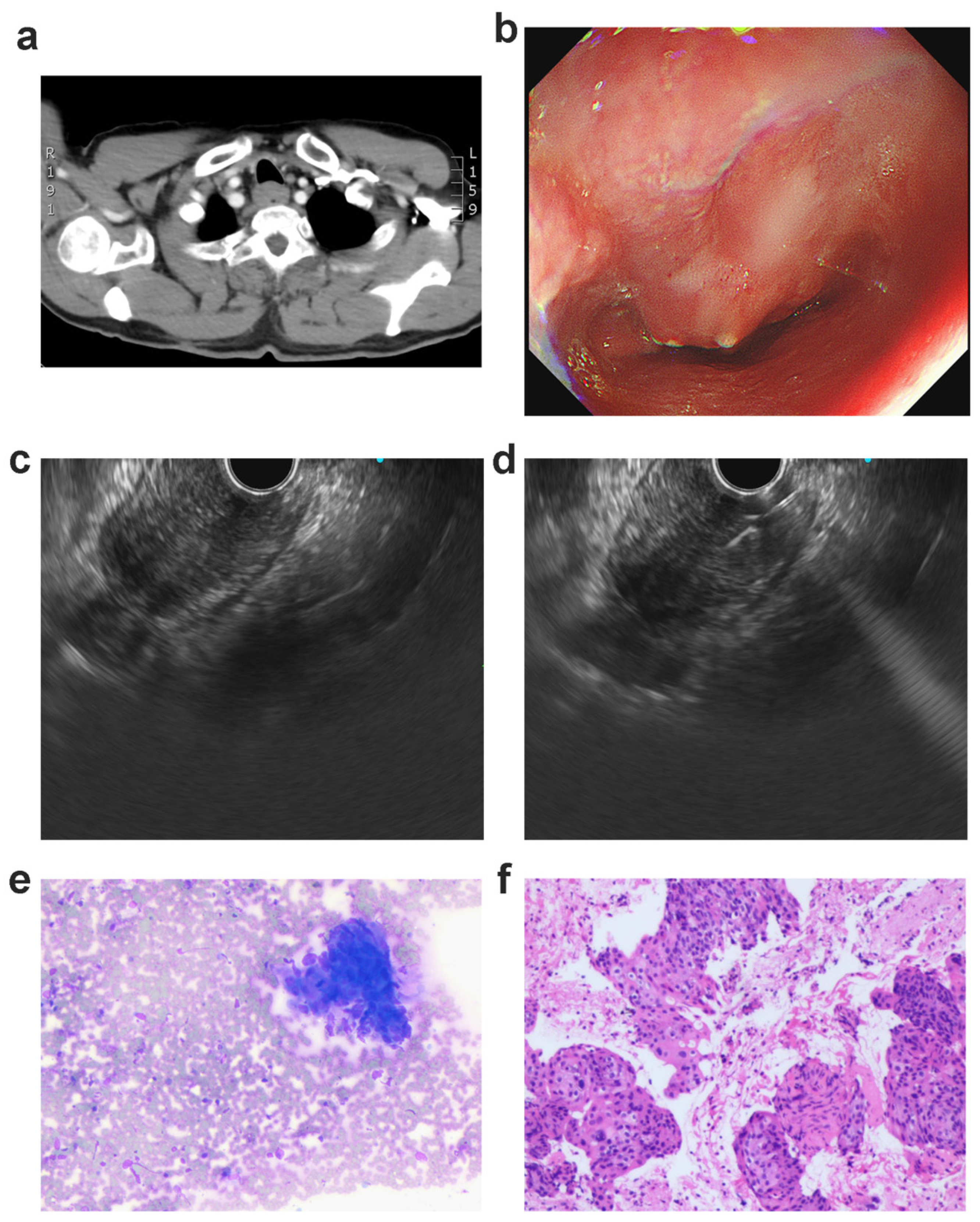 JCM | Free Full-Text | Role of Endoscopic Ultrasound-Guided Fine Needle  Aspiration (EUS-FNA) in the Diagnosis of Suspicious Malignant Esophageal  Strictures