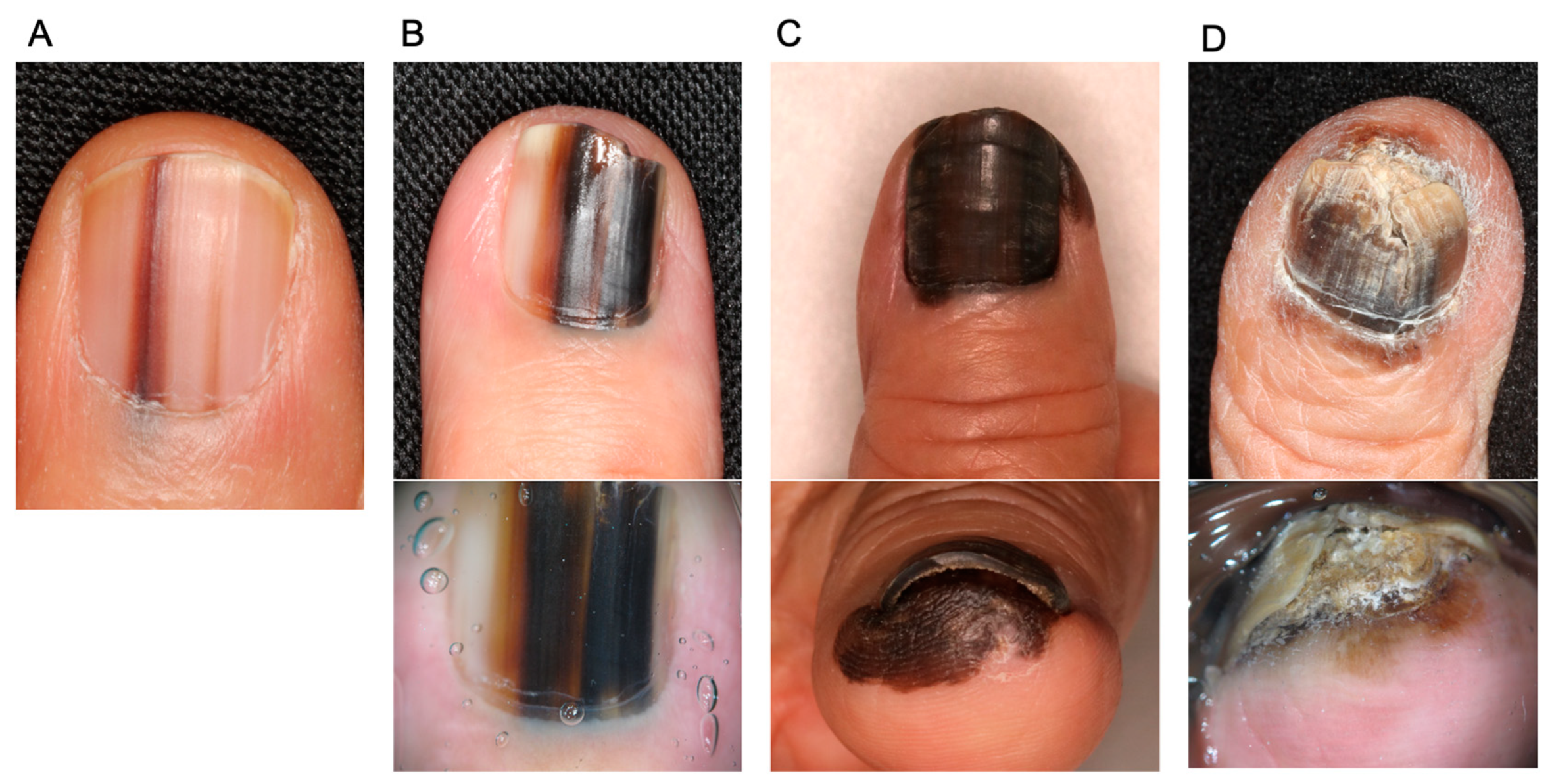 Toenail Fungus Or Melanoma Toenail Fungus Or Melanoma