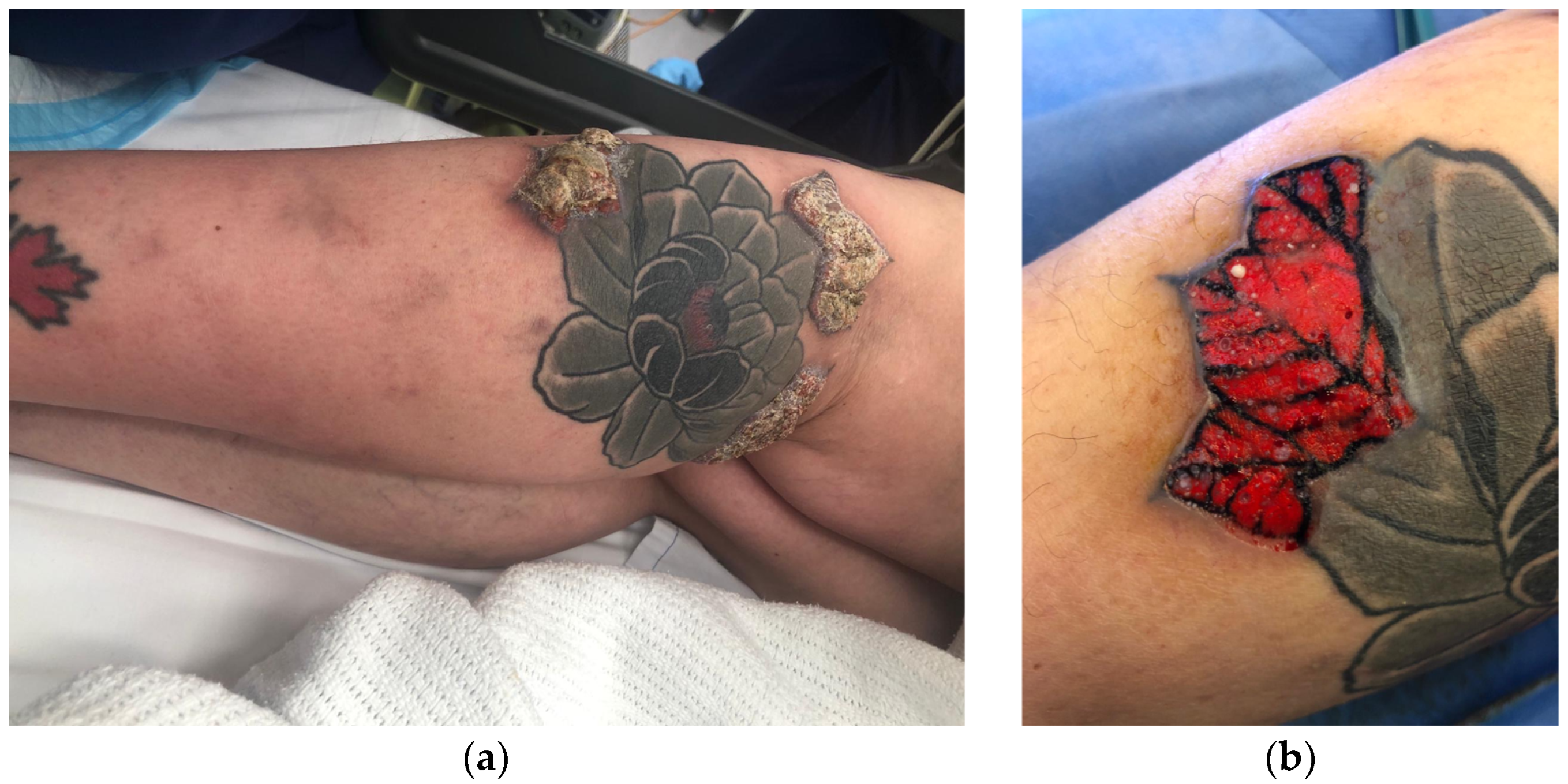 PDF) Sarcoidosis sistémica con afectación del tatuaje