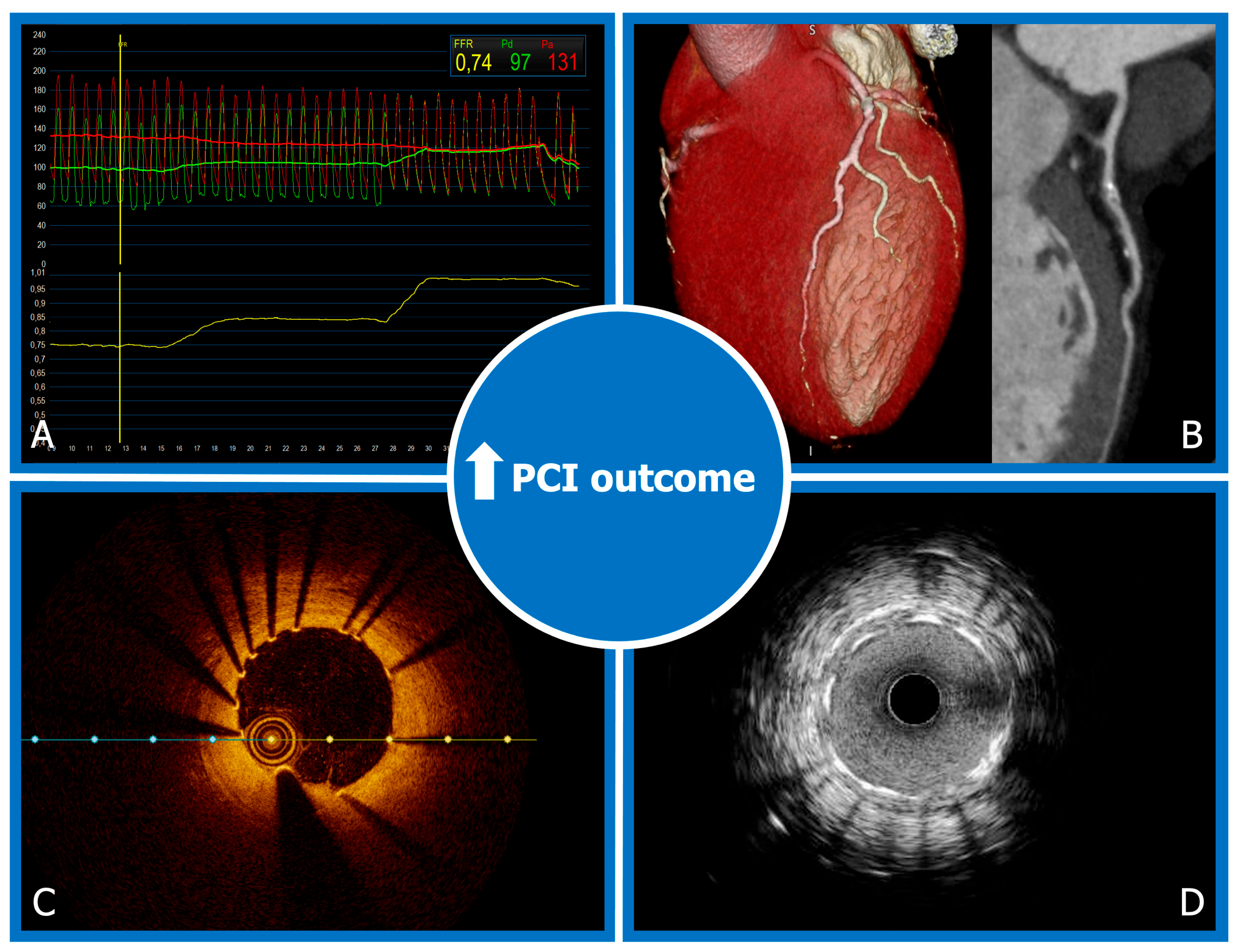 Clinical outcomes of upgrade to versus de novo cardiac