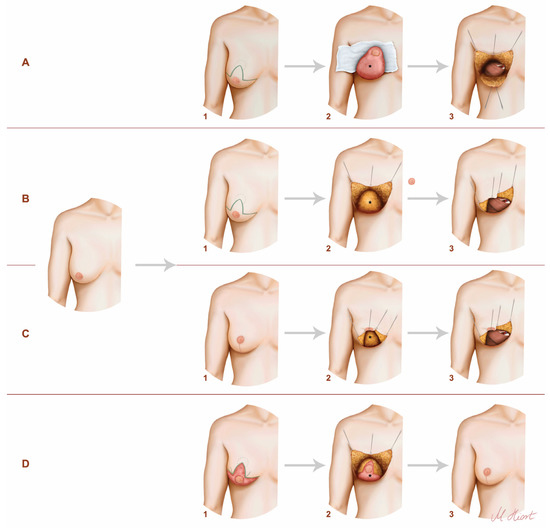 How post mastectomy breast solutions differ from breast implants