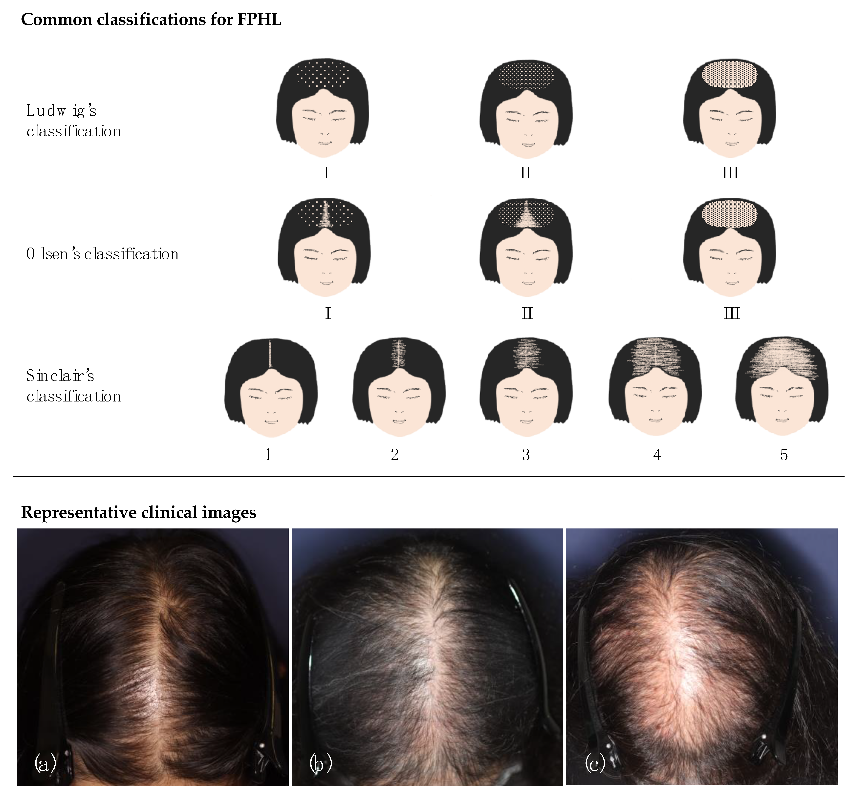 Female Hair loss » VERTEX