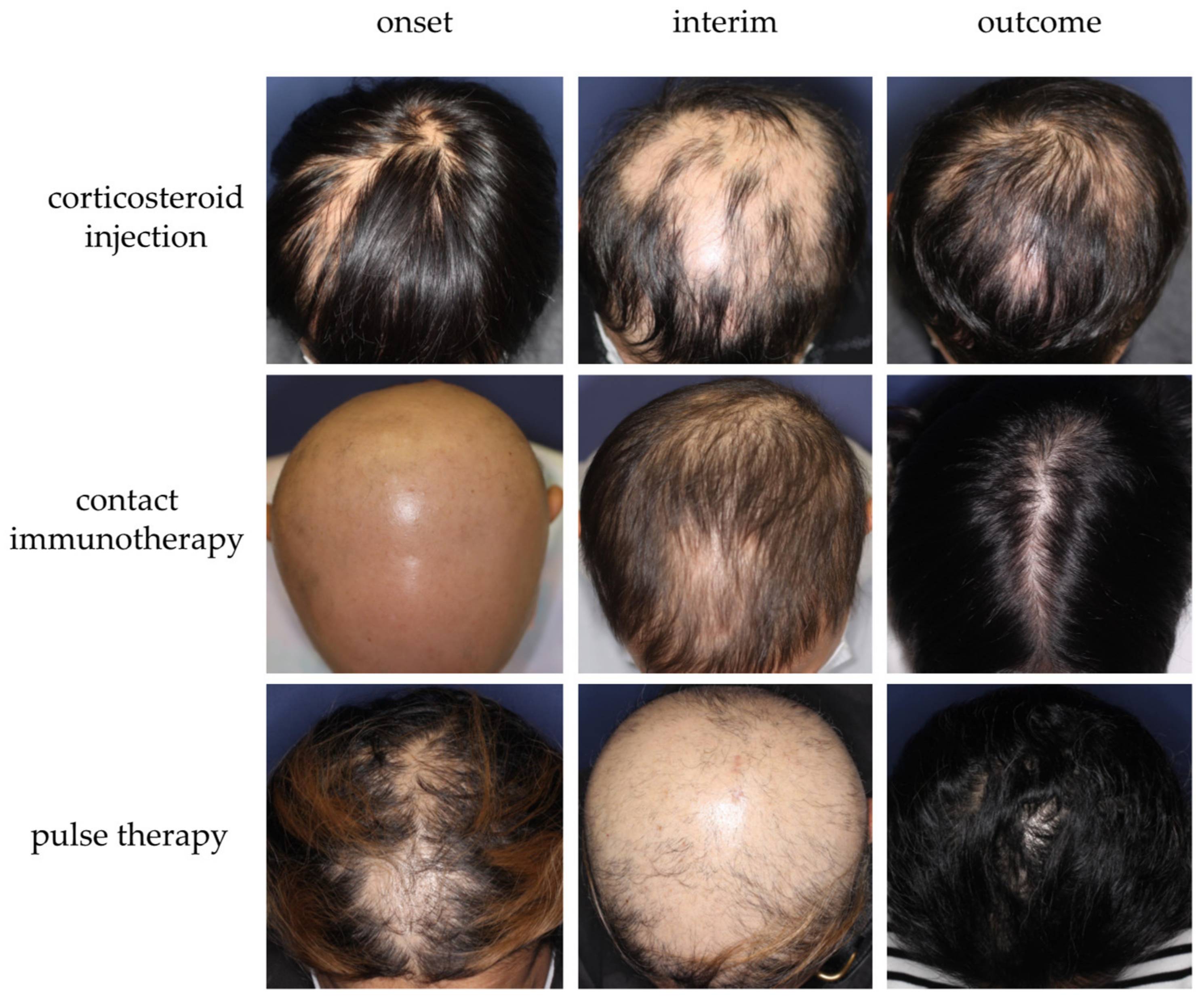 Oral Steroids (Prednisone, Dexamethasone) for Rapidly Progressive Alopecia  Areata: Still an Option — Donovan Hair Clinic