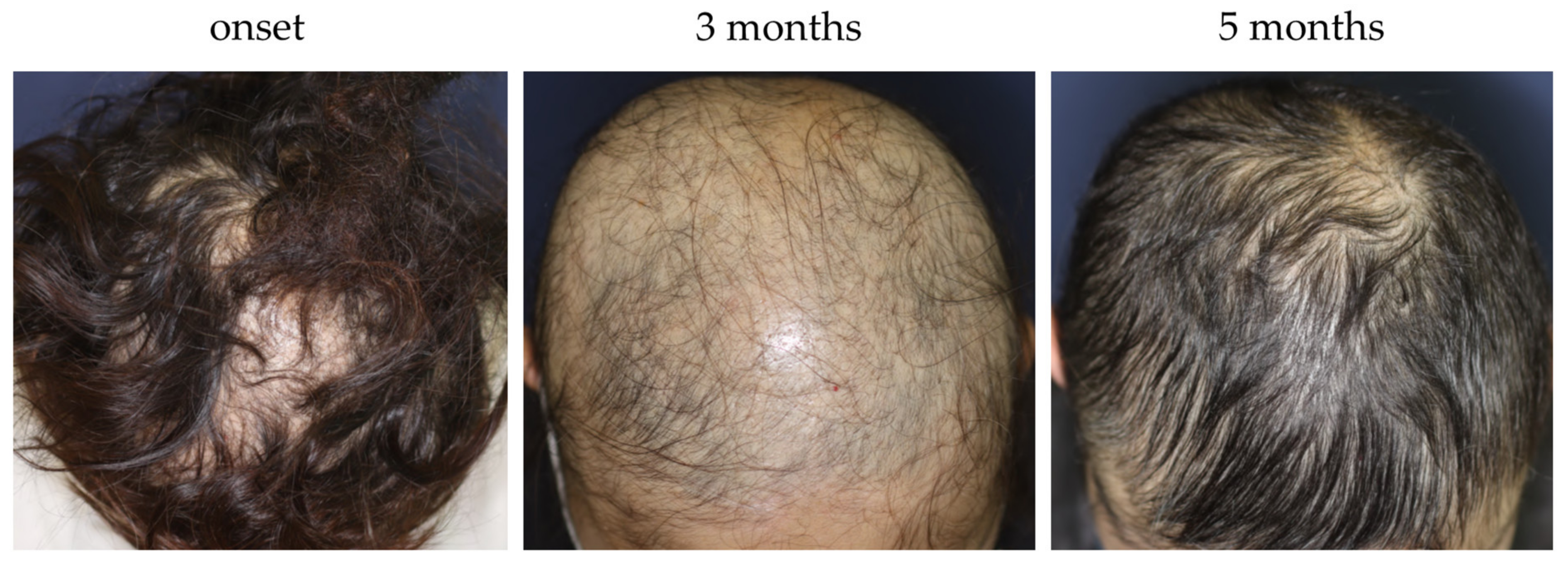 Hair Transplant on 64 Year Old Male with Diffuse Hair Loss  Hair  Restoration of the South