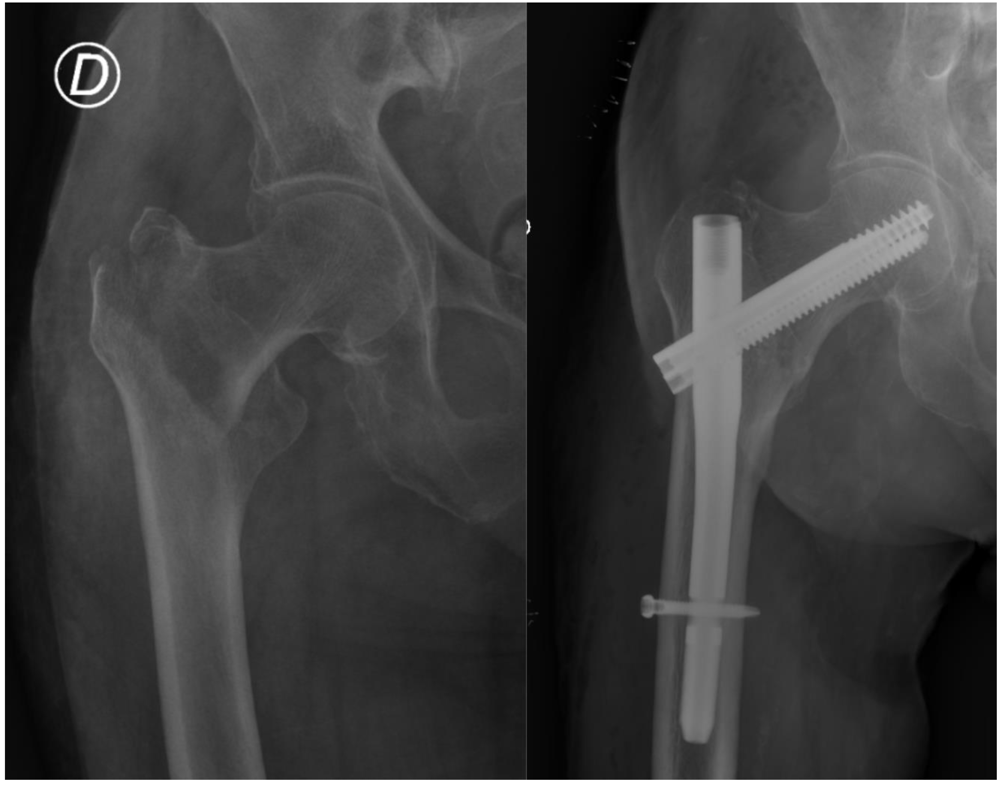 Cureus | Parameters Governing the Fate of Fracture Fixation With Proximal  Femoral Nailing (PFN) for Intertrochanteric Femur Fractures | Article