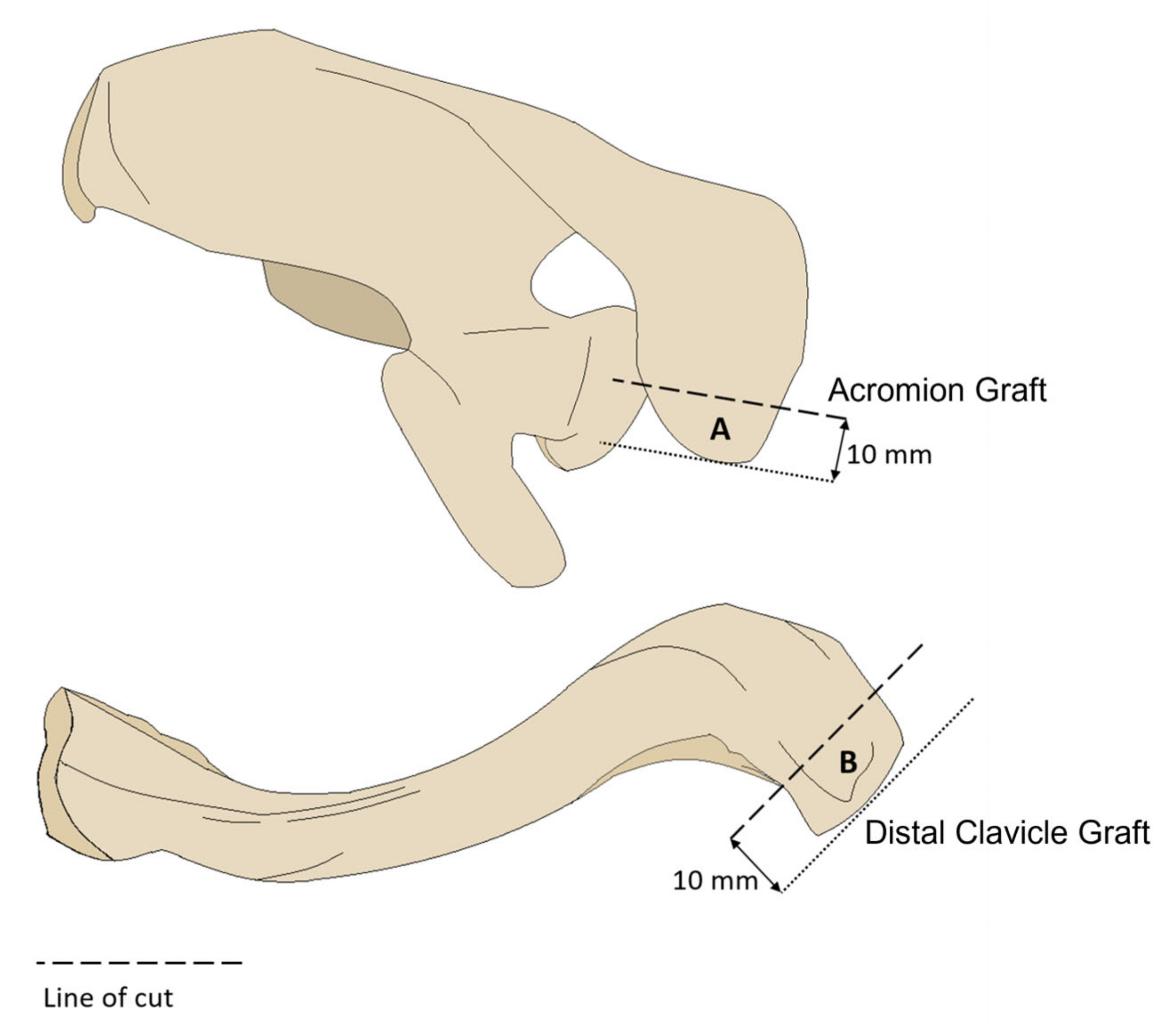 Jcm Free Full Text Acromion And Distal Clavicle Grafts For