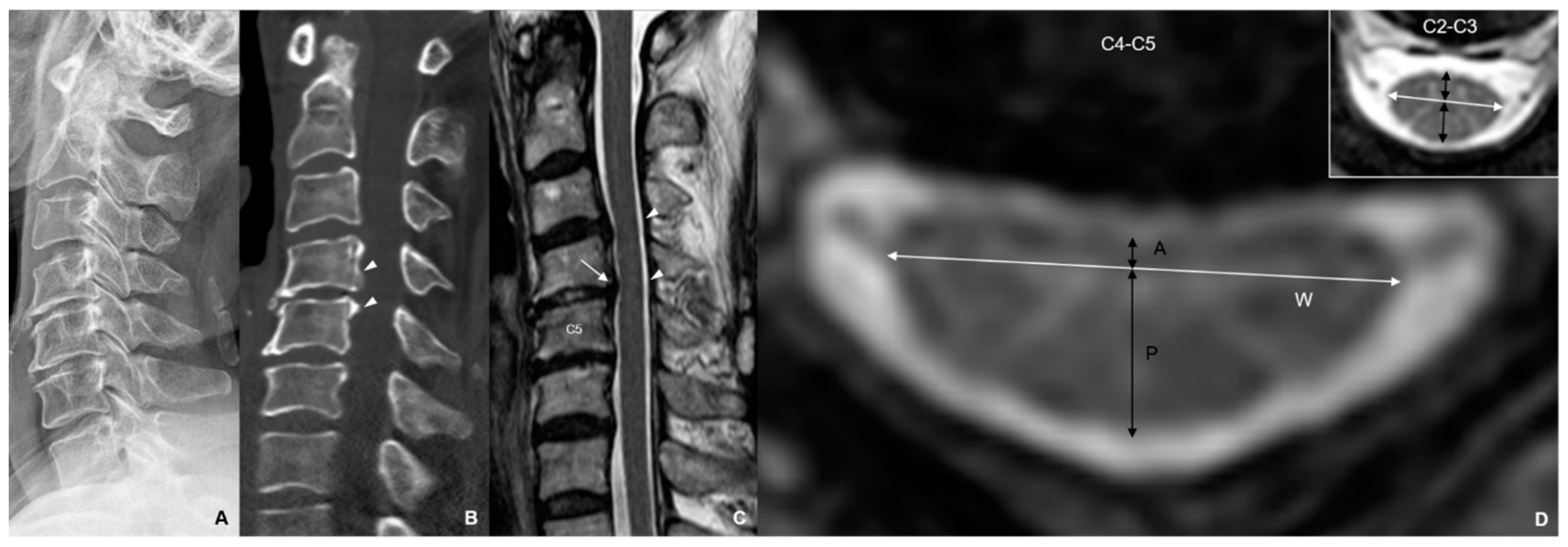 JCM | Free Full-Text | Difference Between Anterior And Posterior Cord ...