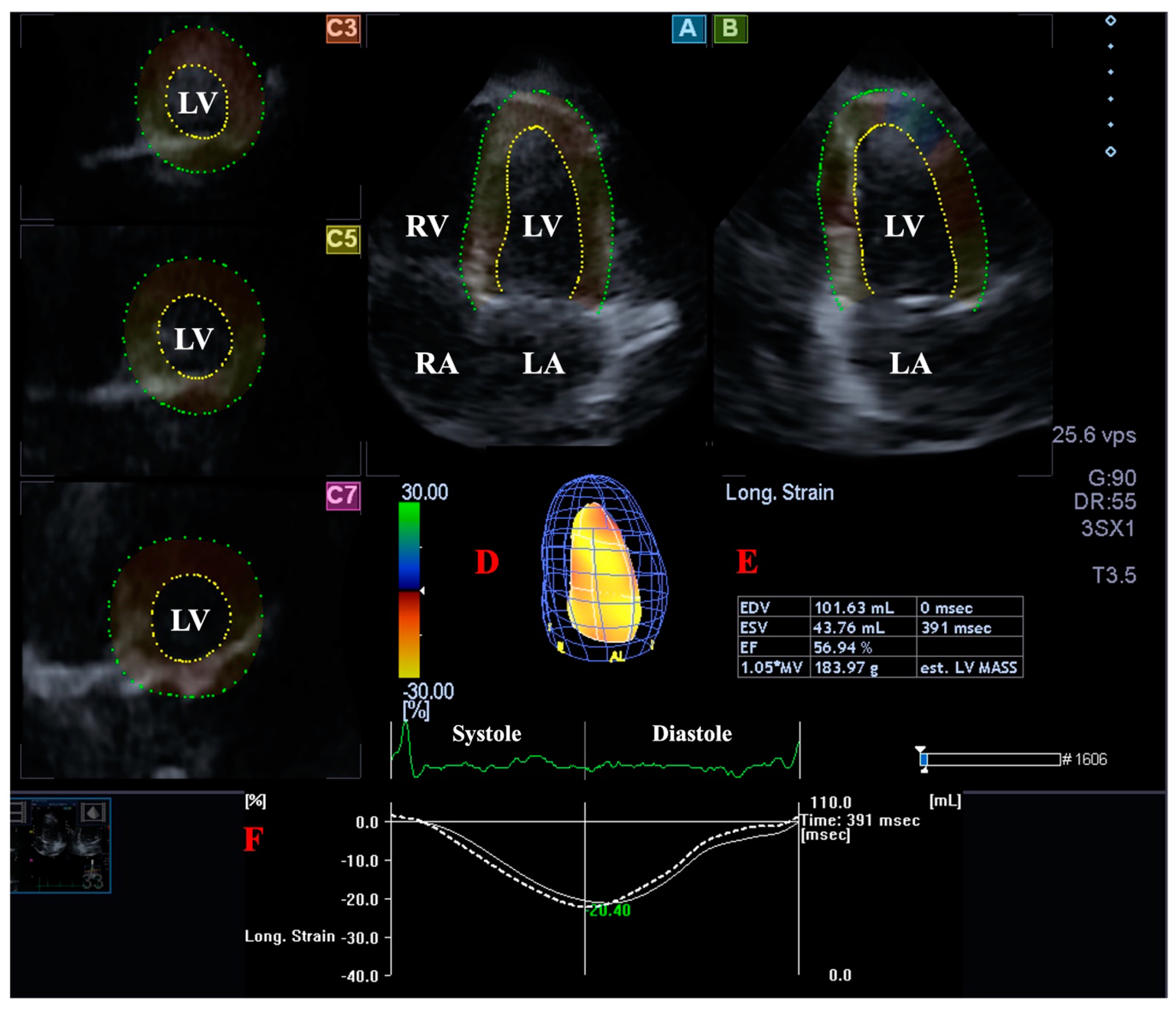 Speckle tracking echocardiography to assess regional ventricular function  in patients with apical hypertrophic cardiomyopathy