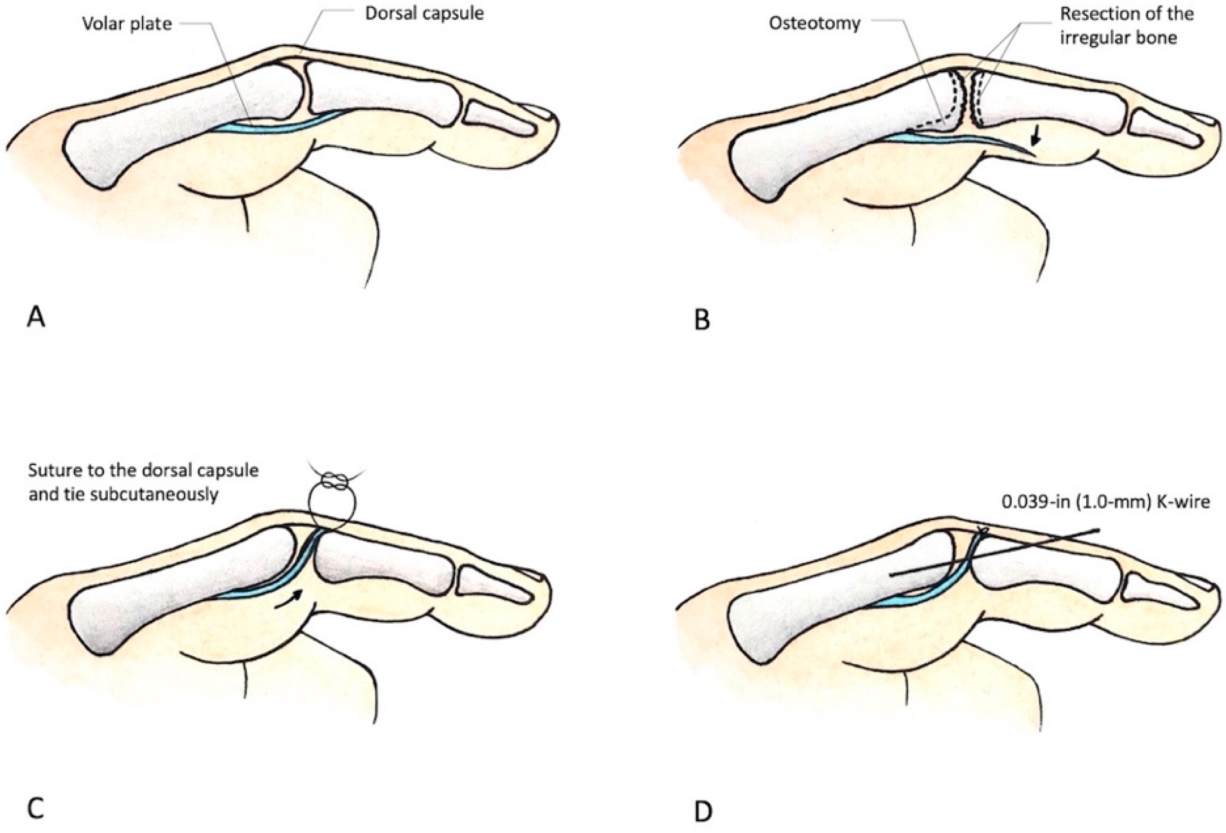 Finger Joint Volar Plate At Ava Ewers Blog Finger Joint Volar Plate At Ava Ewers Blog