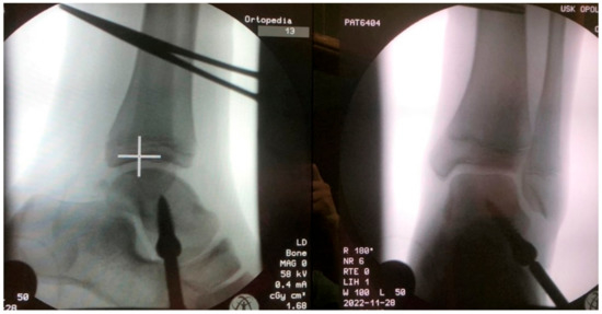 JCM | Free Full-Text | Short-Term and Medium-Term Radiological and ...