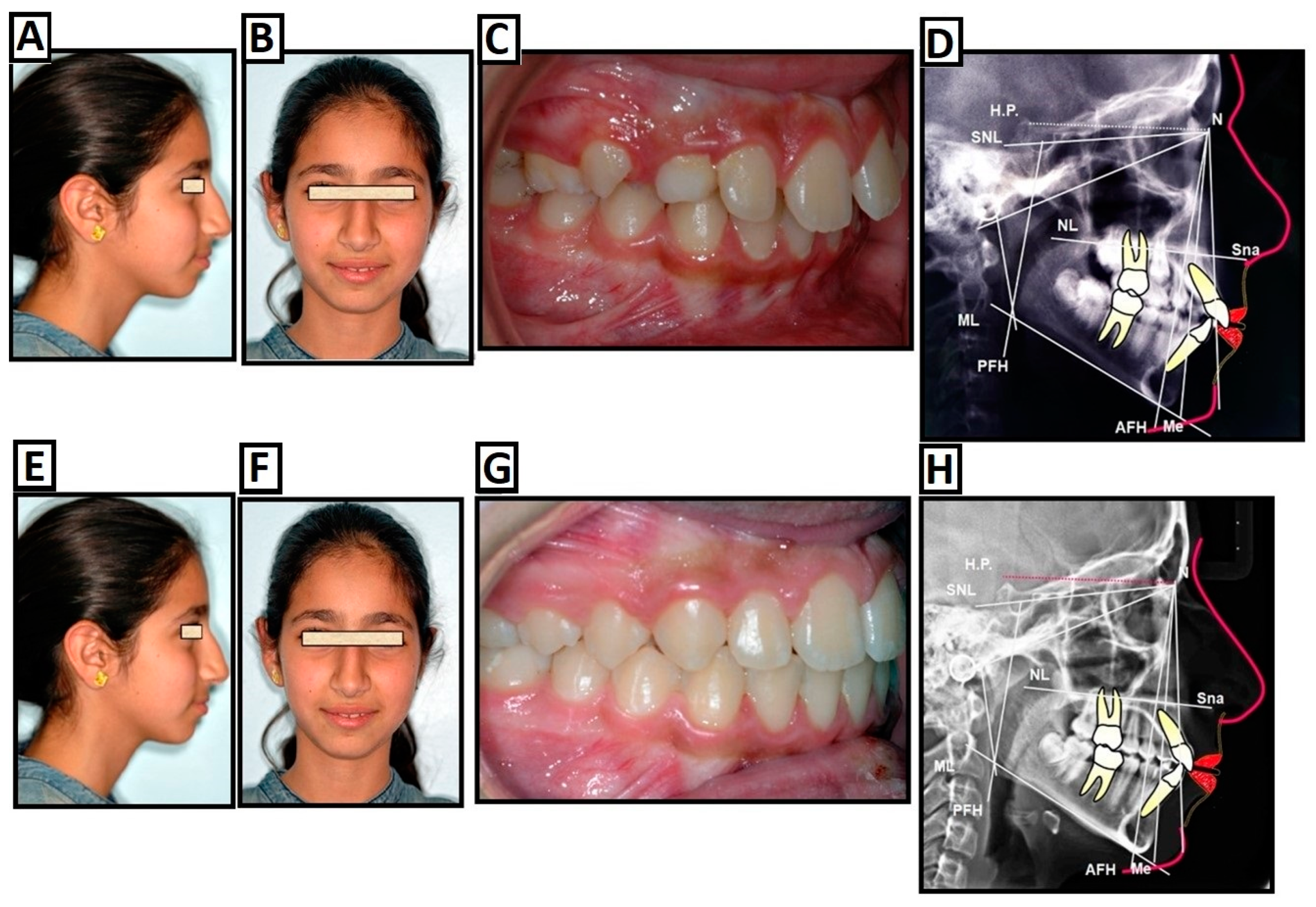 Management of Skeletal Class II Malocclusion by Surgery-First Approach – A  Short Term Clinical Experience