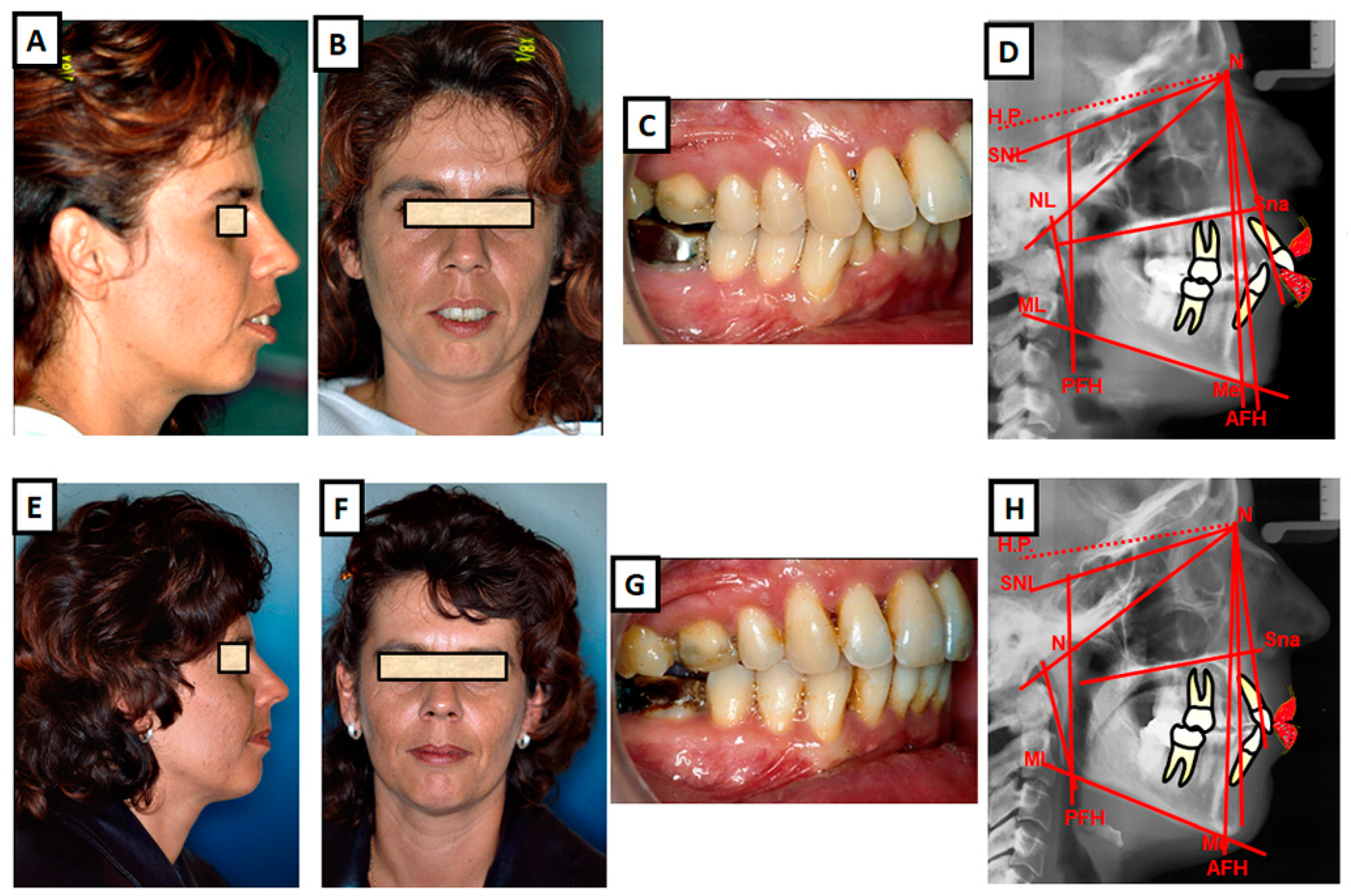 Adult patient with Class II, Div. 2 malocclusion and collapse of