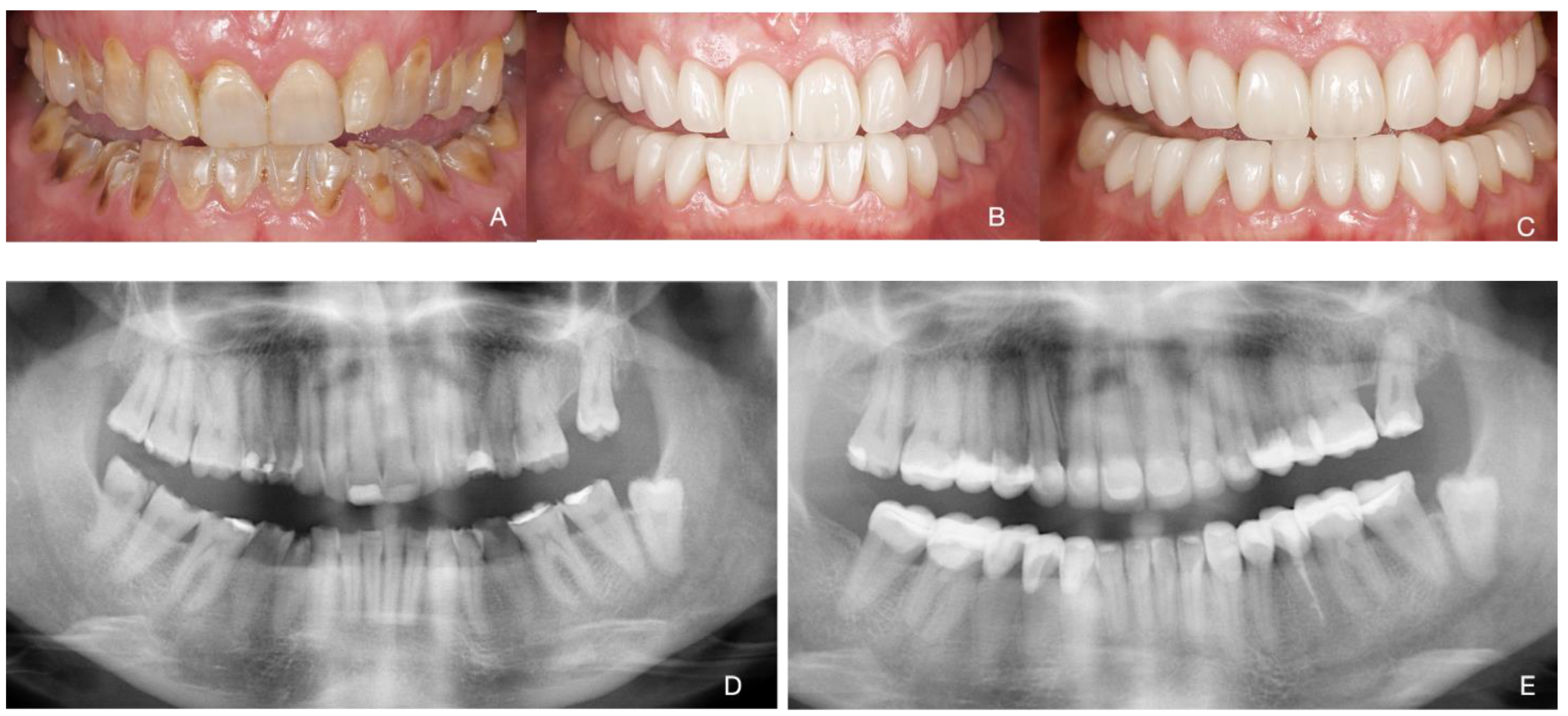 Dental Implants: A Permanent Solution for Missing Teeth in Cuenca, Ecuador  