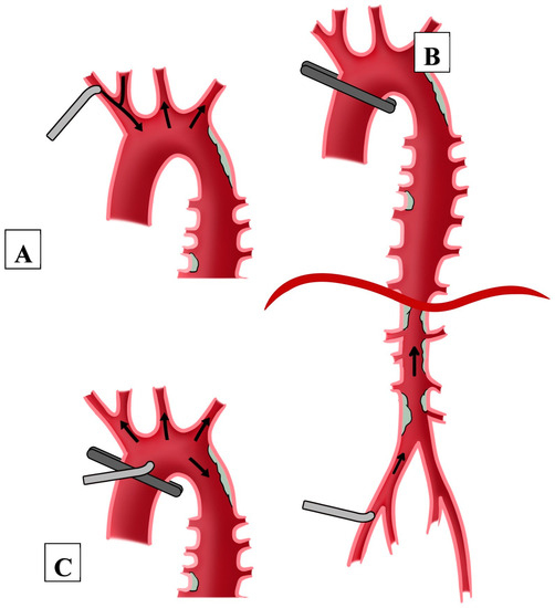 JCM | Free Full-Text | Femoral or Axillary Cannulation for ...