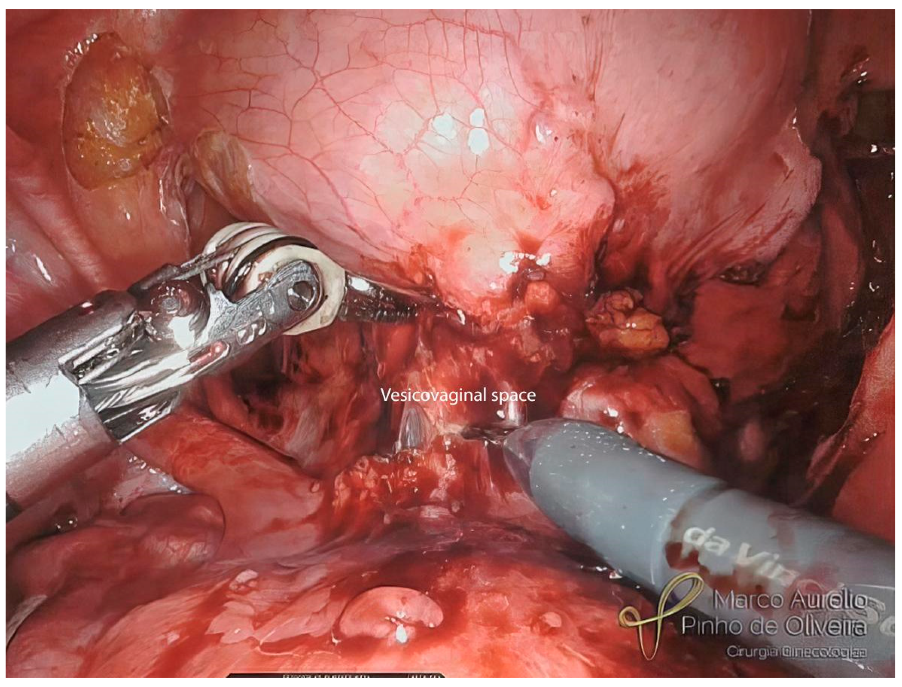 Laparoendoscopic single-site surgery for deep infiltrating