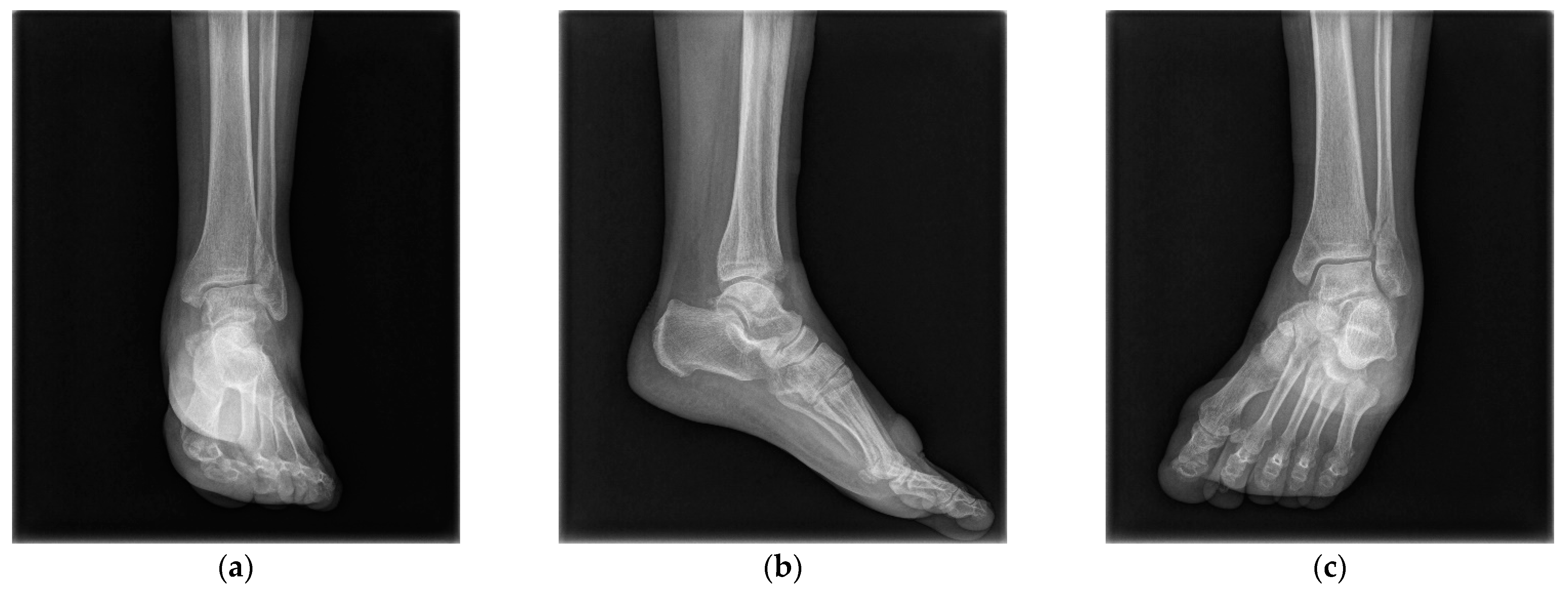 Acute syndesmotic injuries in ankle fractures: From diagnosis to treatment  and current concepts
