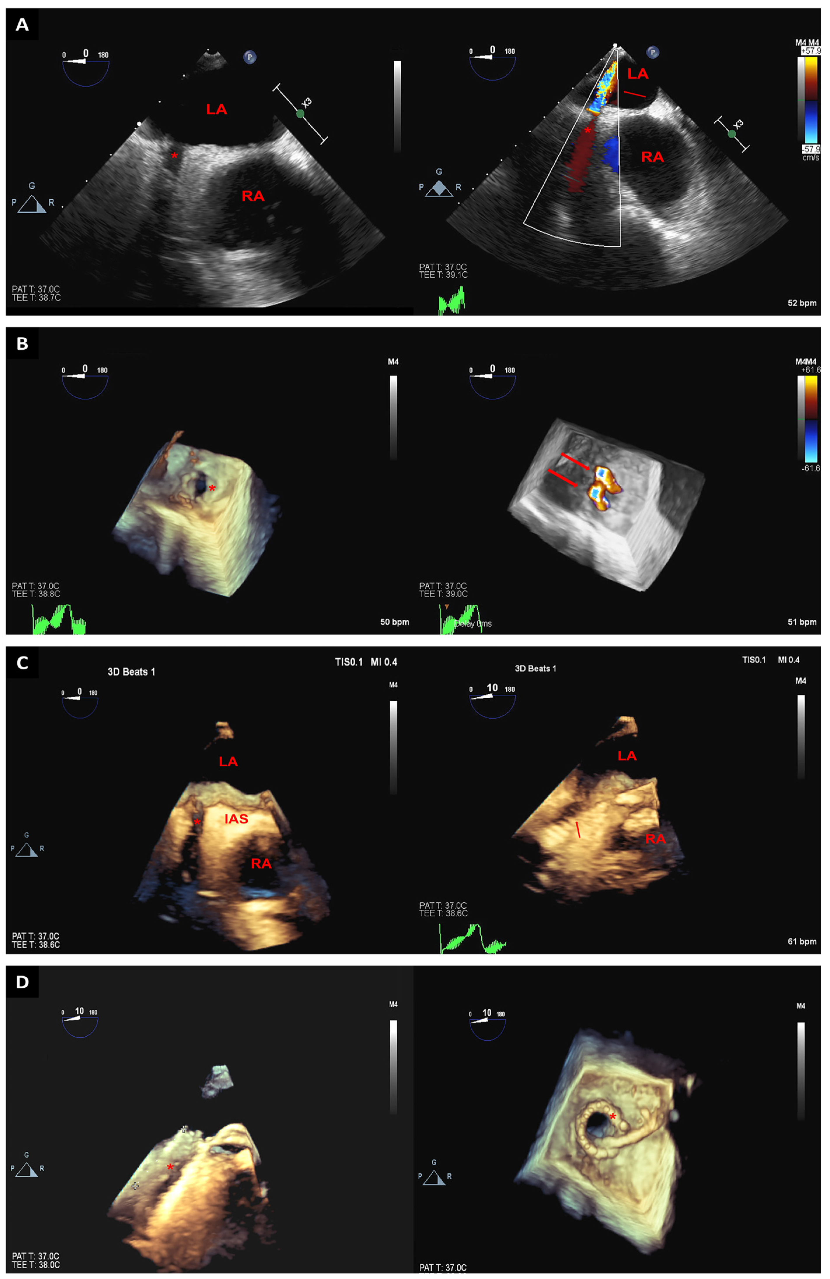 Virtual TEE: Standard Views, Cardiac, Transesophageal Echocardiography, 3D  Heart Model, Education