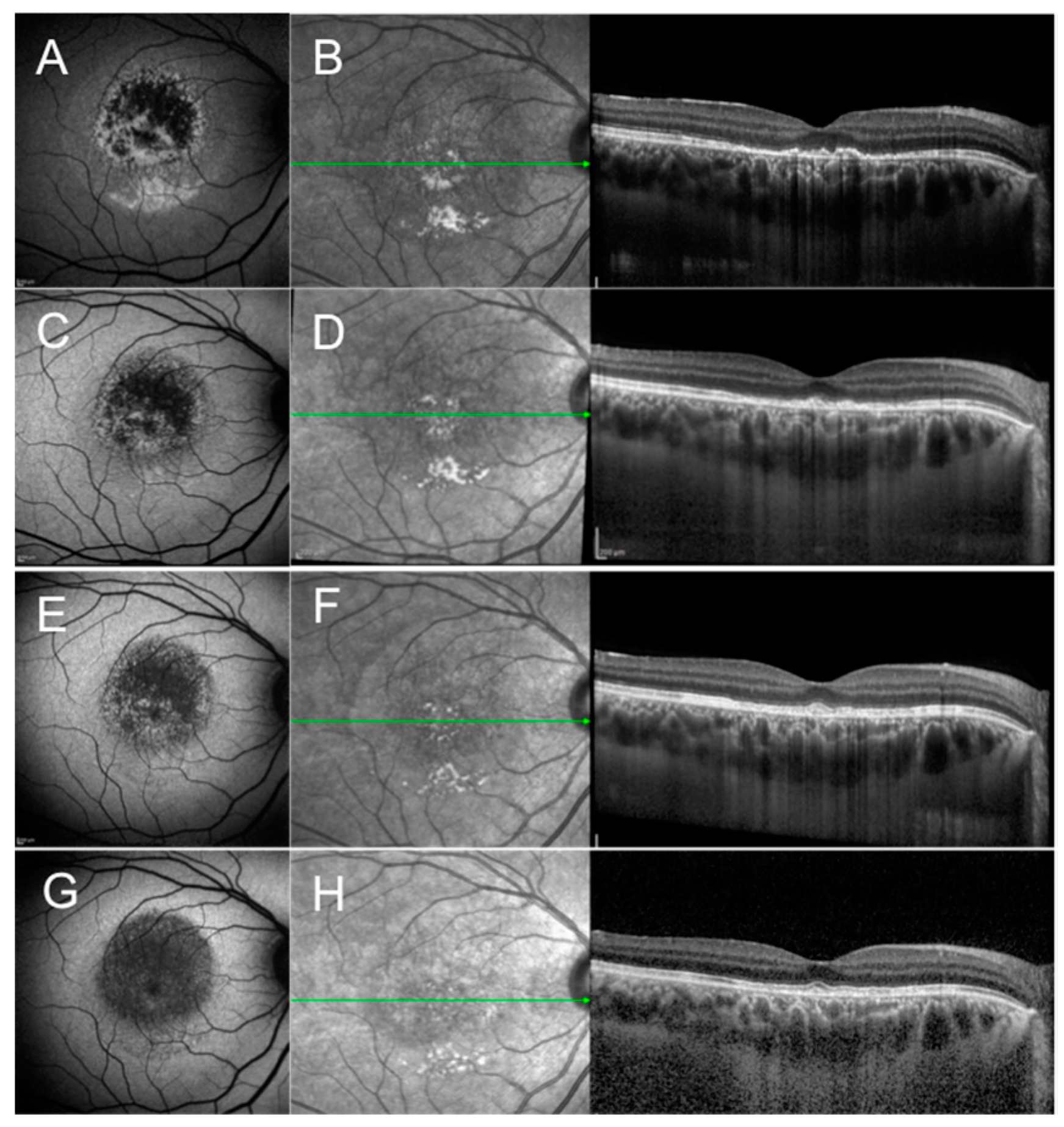 Infectious optic neuropathies: a clinical update | EB