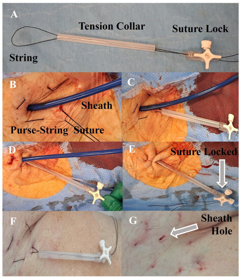 Figure 2 from A Novel Purse-String Suture and Dehydrated Human  Amnion/Chorion Membrane Allograft Closure Technique for the Repair of  Defects Following Mohs Micrographic and Excisional Surgery | Semantic  Scholar