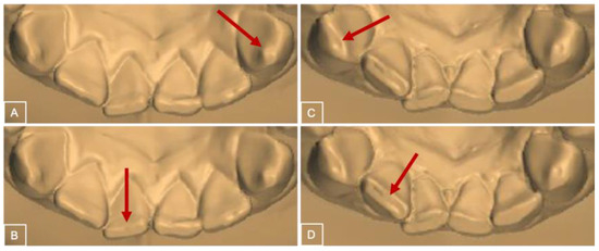 JCM | Free Full-Text | 60 Normal to Longitudinal Occlusion: Tooth up Wear in Erosive with the of A Study Age Pioneering Subjects