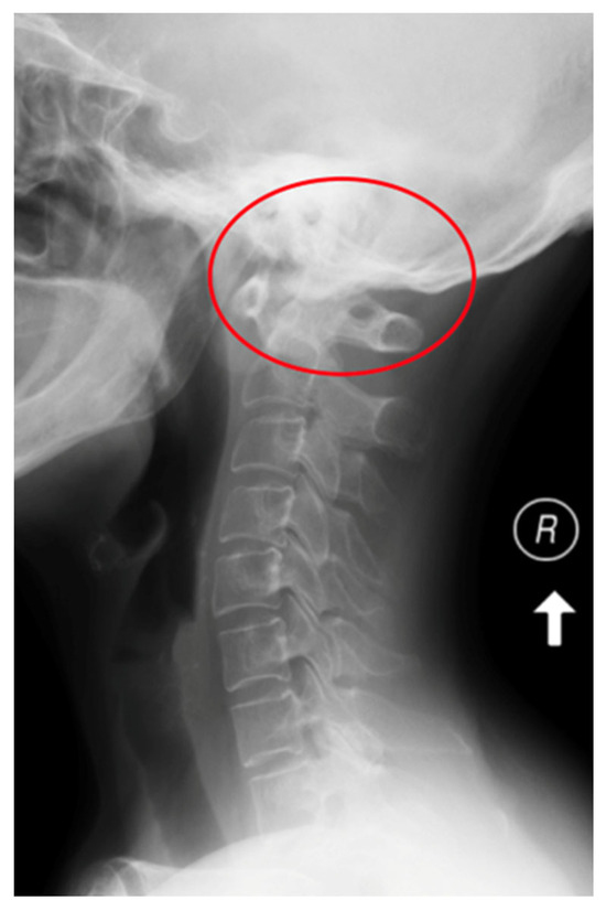 Relationship between Cervical Instability in the Course of Rheumatoid ...