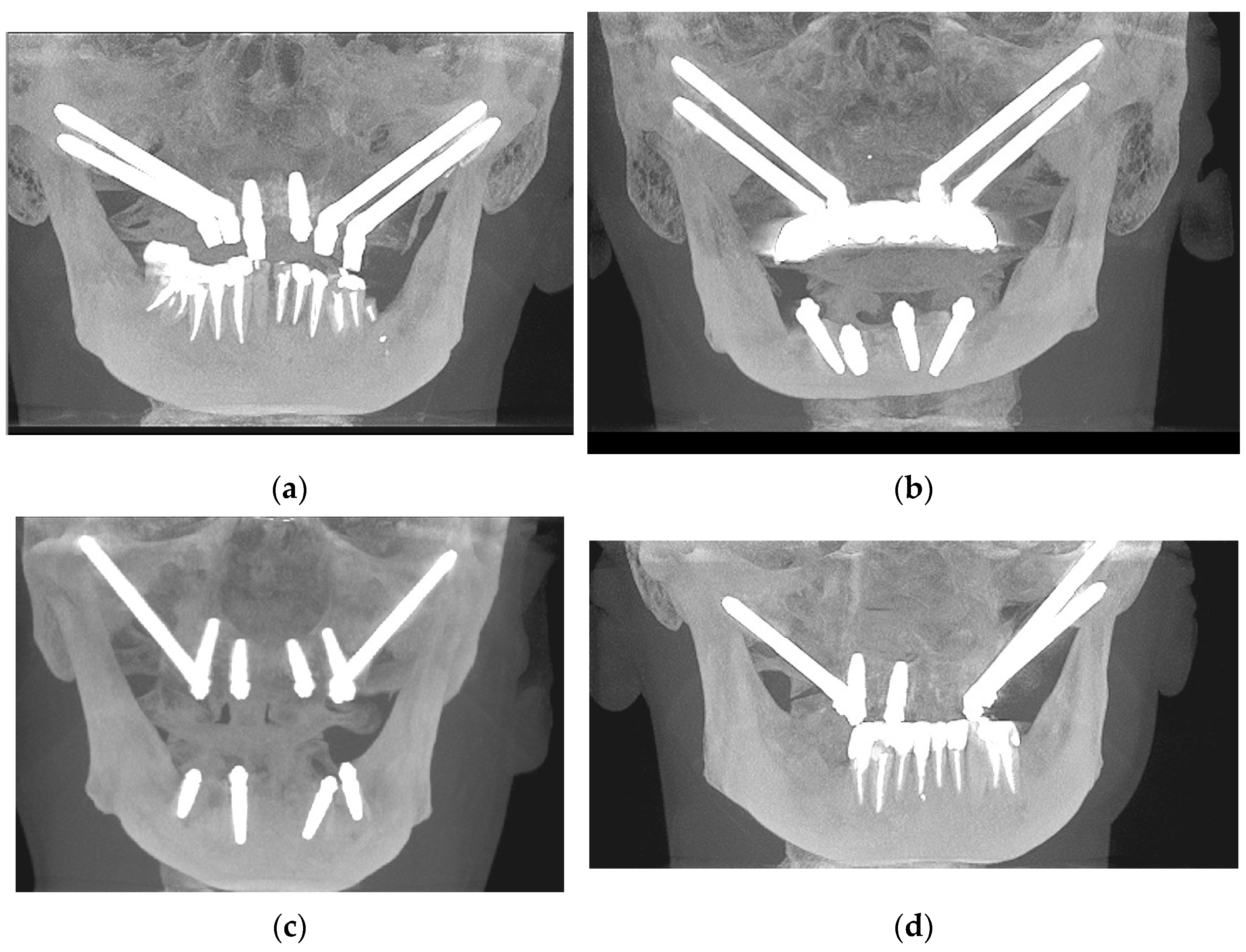 JCM Free Full Text The Zygomatic Anatomy Guided Approach