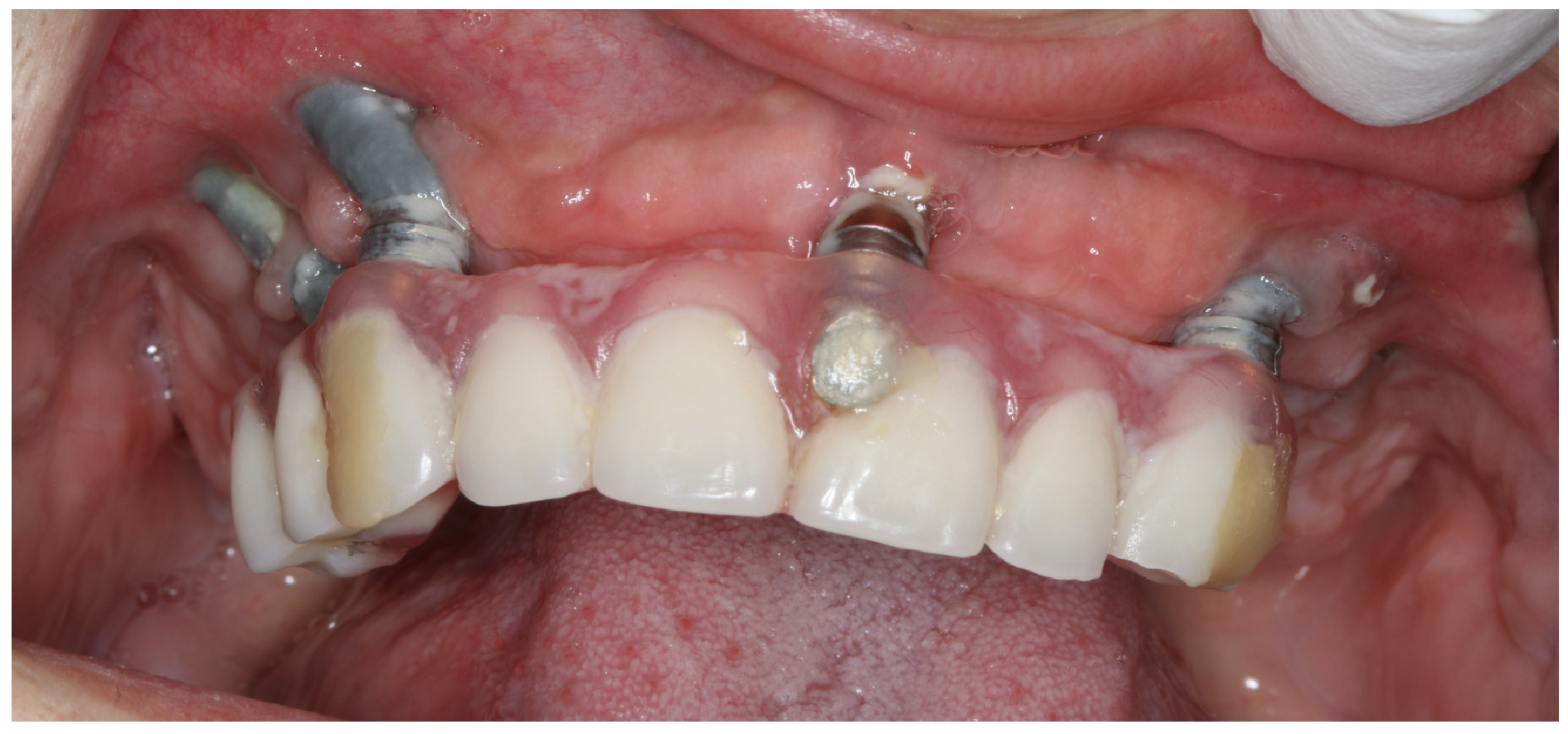 JCM Free Full Text The Zygomatic Anatomy Guided Approach