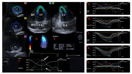 Novel Echocardiography-Derived Left Ventricular Stiffness Index in