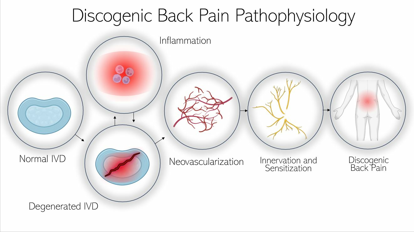 Basic Fact Sheet about Low Back Pain - StemCell ARTS