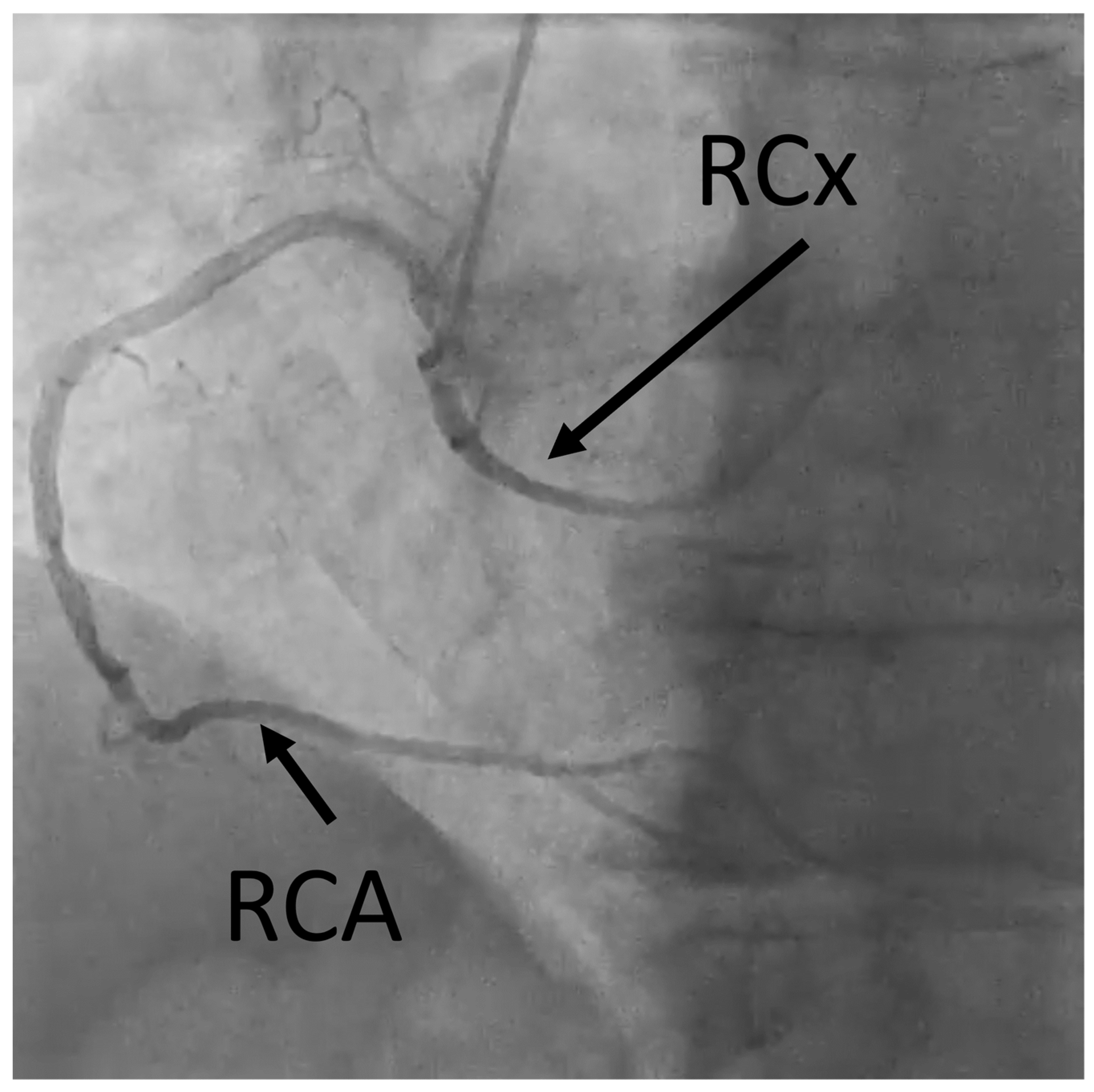 Anomalous Origin Of Left Circumflex Artery From The Right Sinus Of Anomalous Origin Of Left Circumflex Artery From The Right Sinus Of